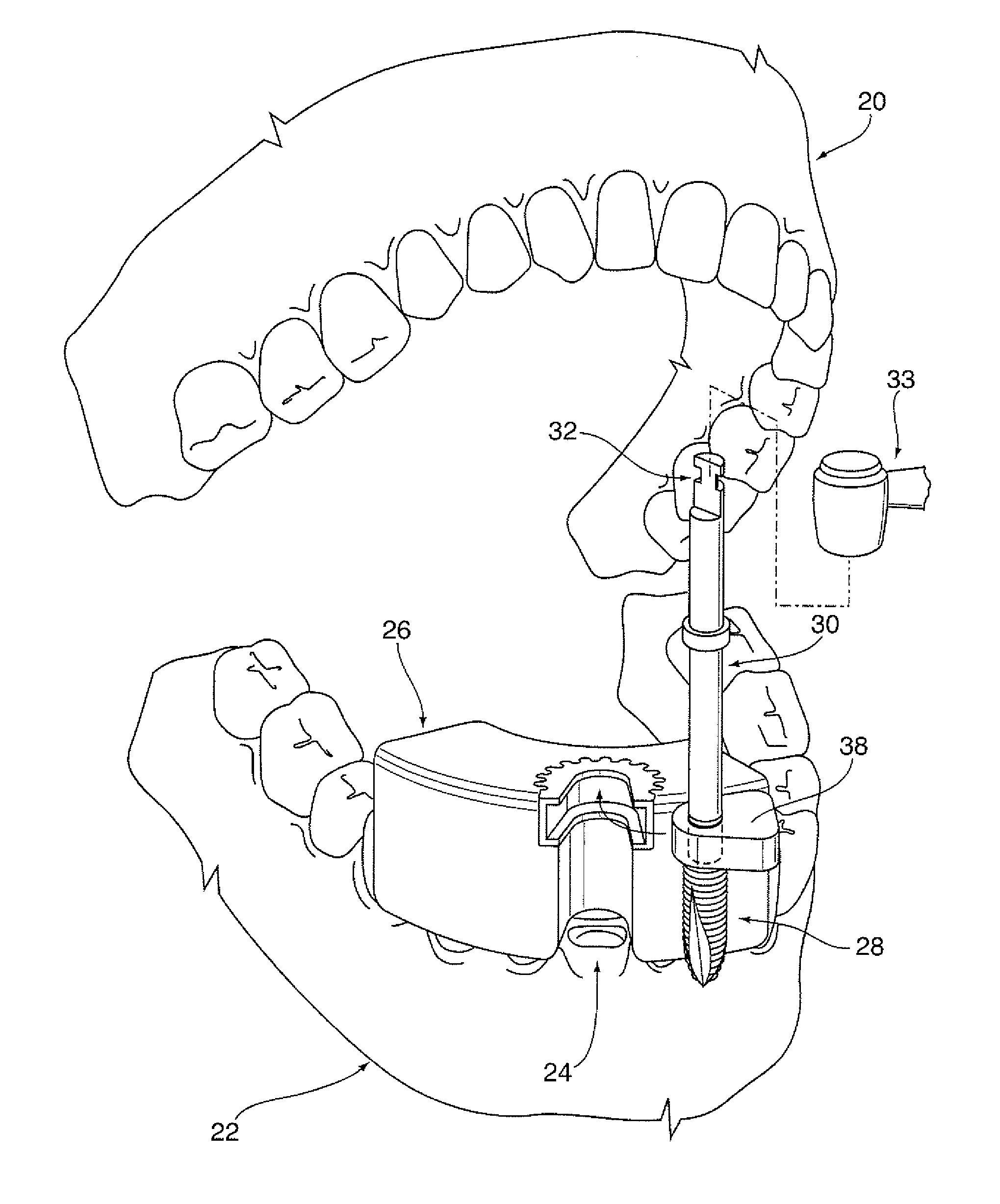 Dental implant positioning system