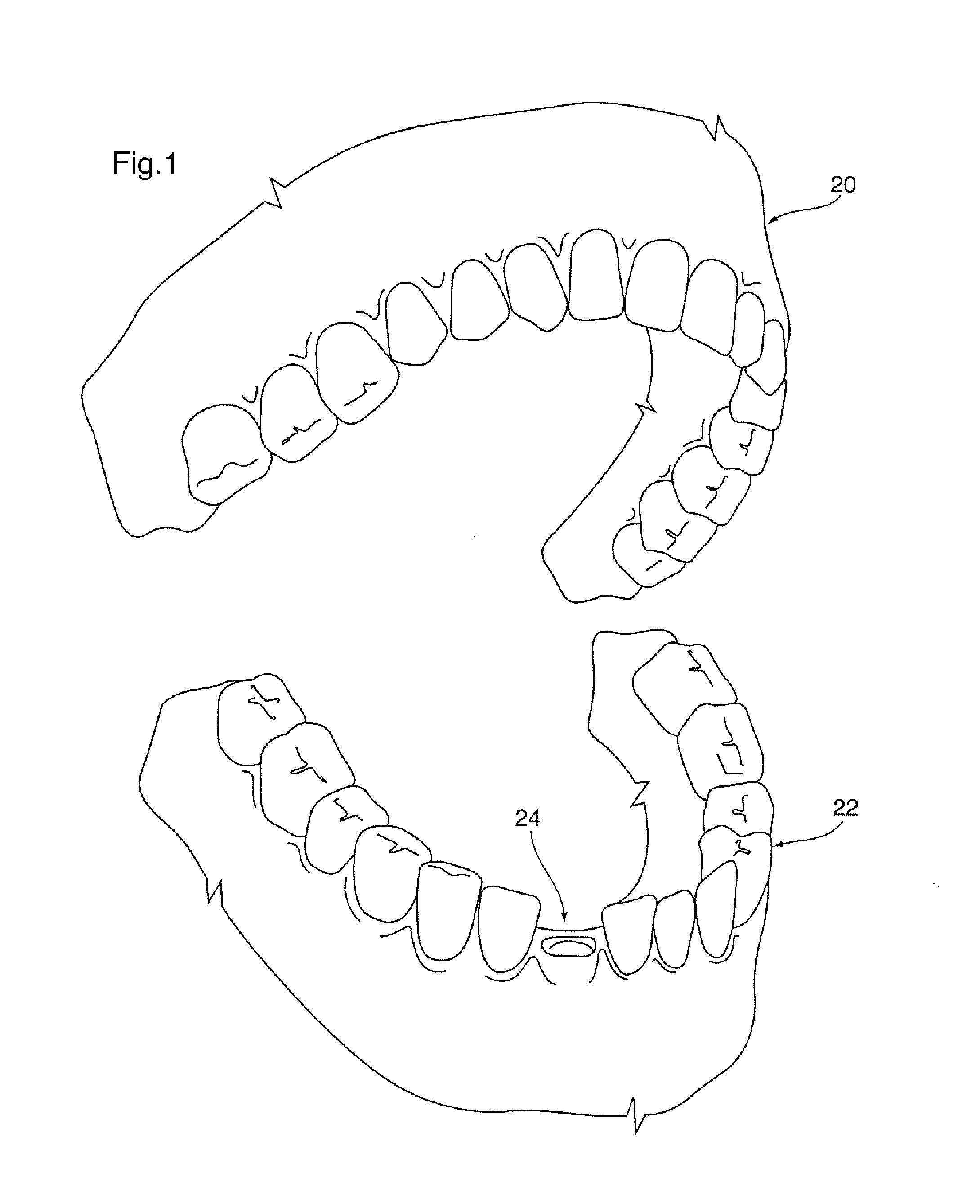 Dental implant positioning system