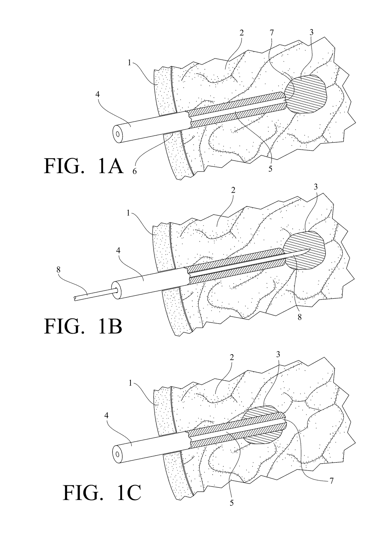 Interstitial ultrasonic disposable applicator and method for tissue thermal conformal volume ablation and monitoring the same