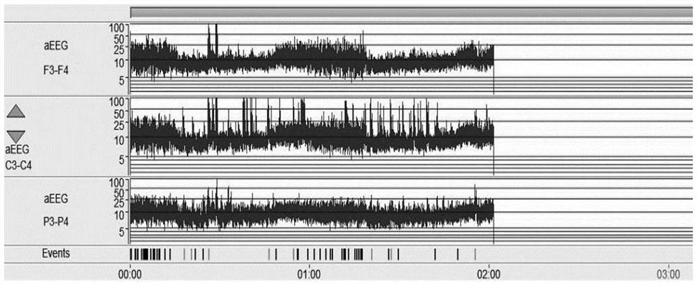 Sleep awakening period analysis method based on amplitude integrated electroencephalogram