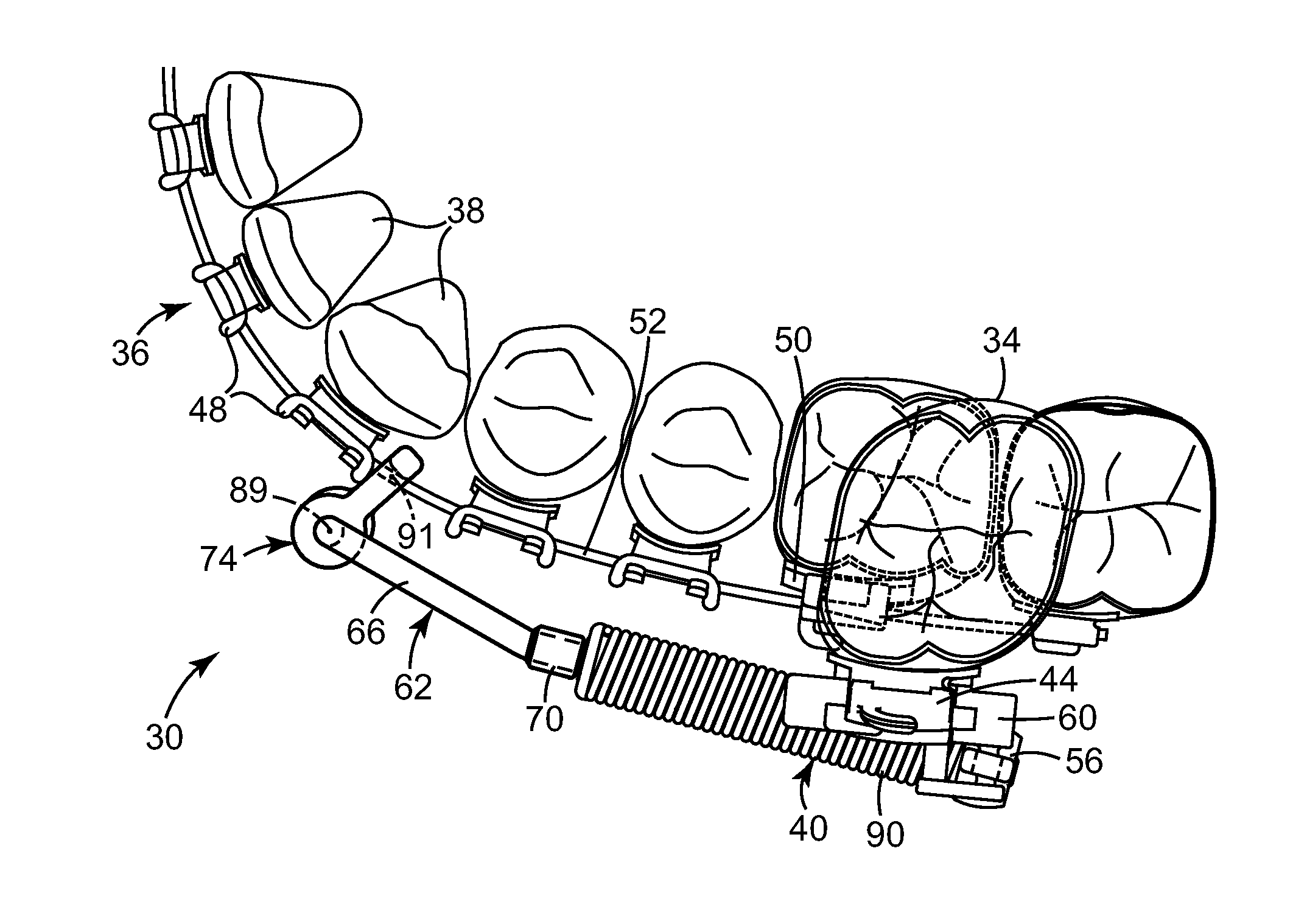 Interarch force module with link for orthodontic treatment