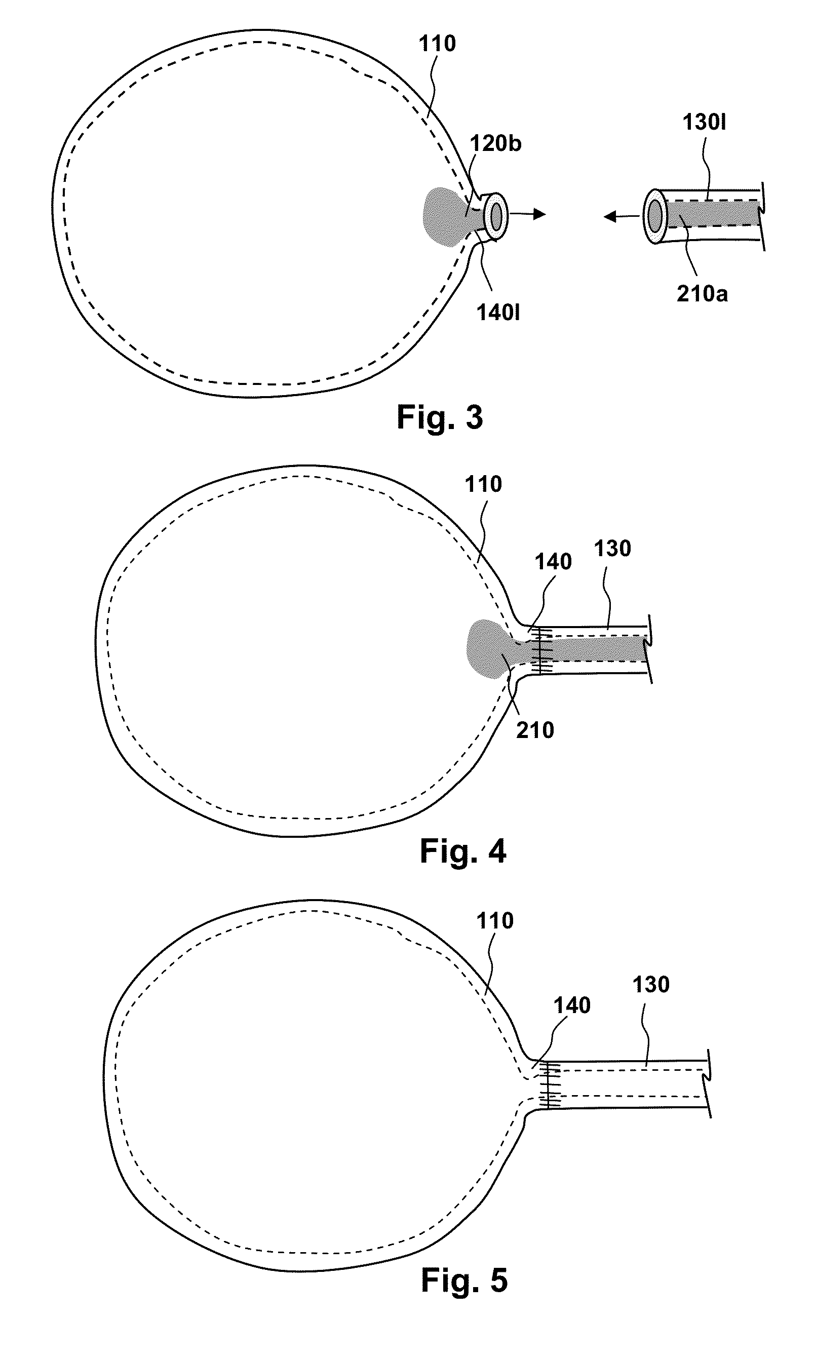 Methods, compositions and kits for performing anastomosis procedures in conjunction with a radical prostatectomy procedure