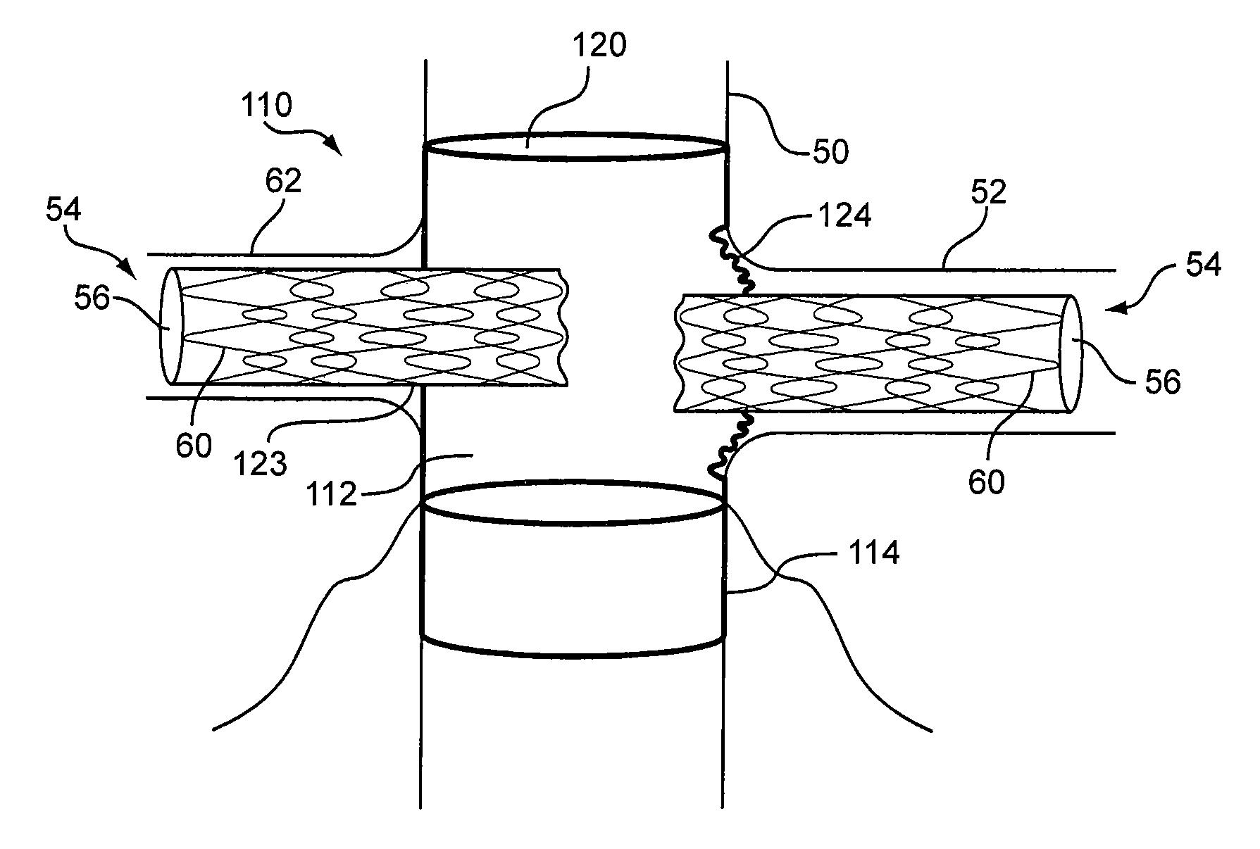 Prosthesis with Moveable Fenestration