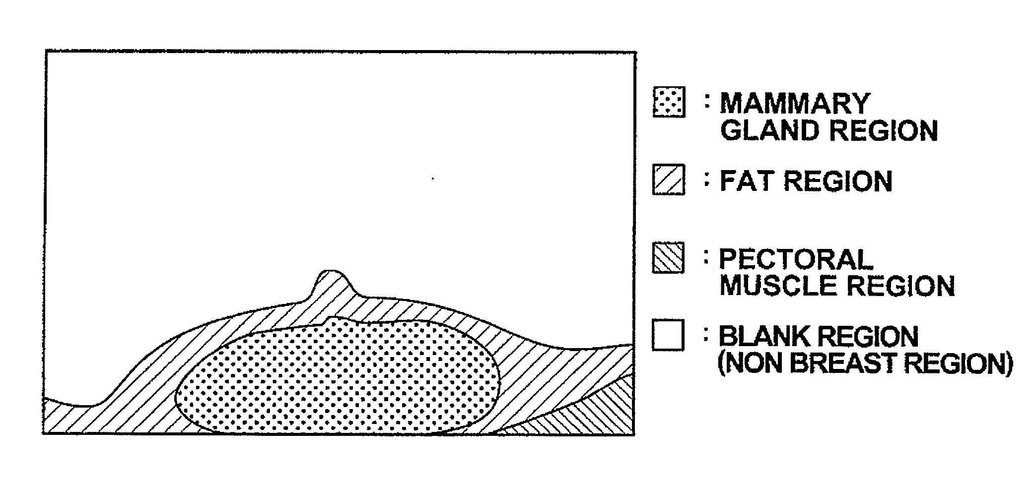 Radiation image processing apparatus, radiation image processing method, and radiation image processing program