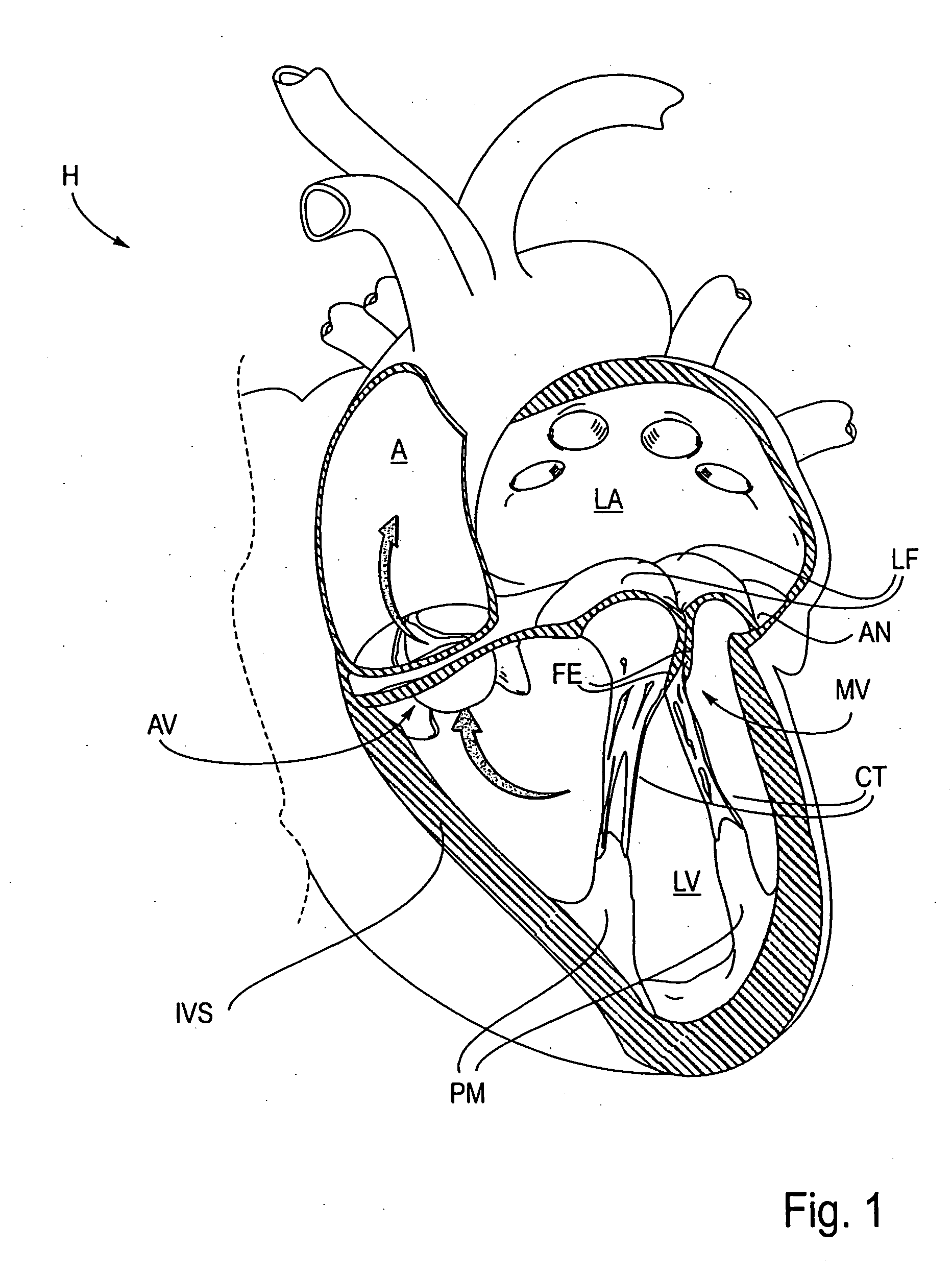 Methods and devices for capturing and fixing leaflets in valve repair