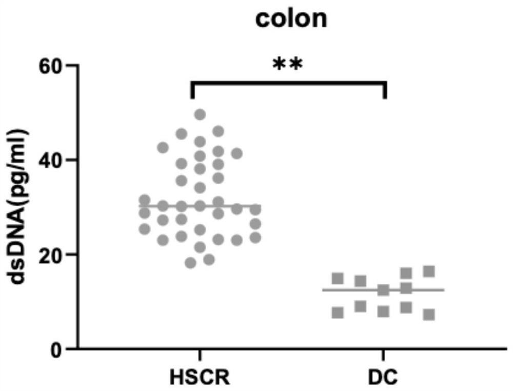 Application of anti-double-stranded DNA antibody as congenital megacolon diagnostic marker