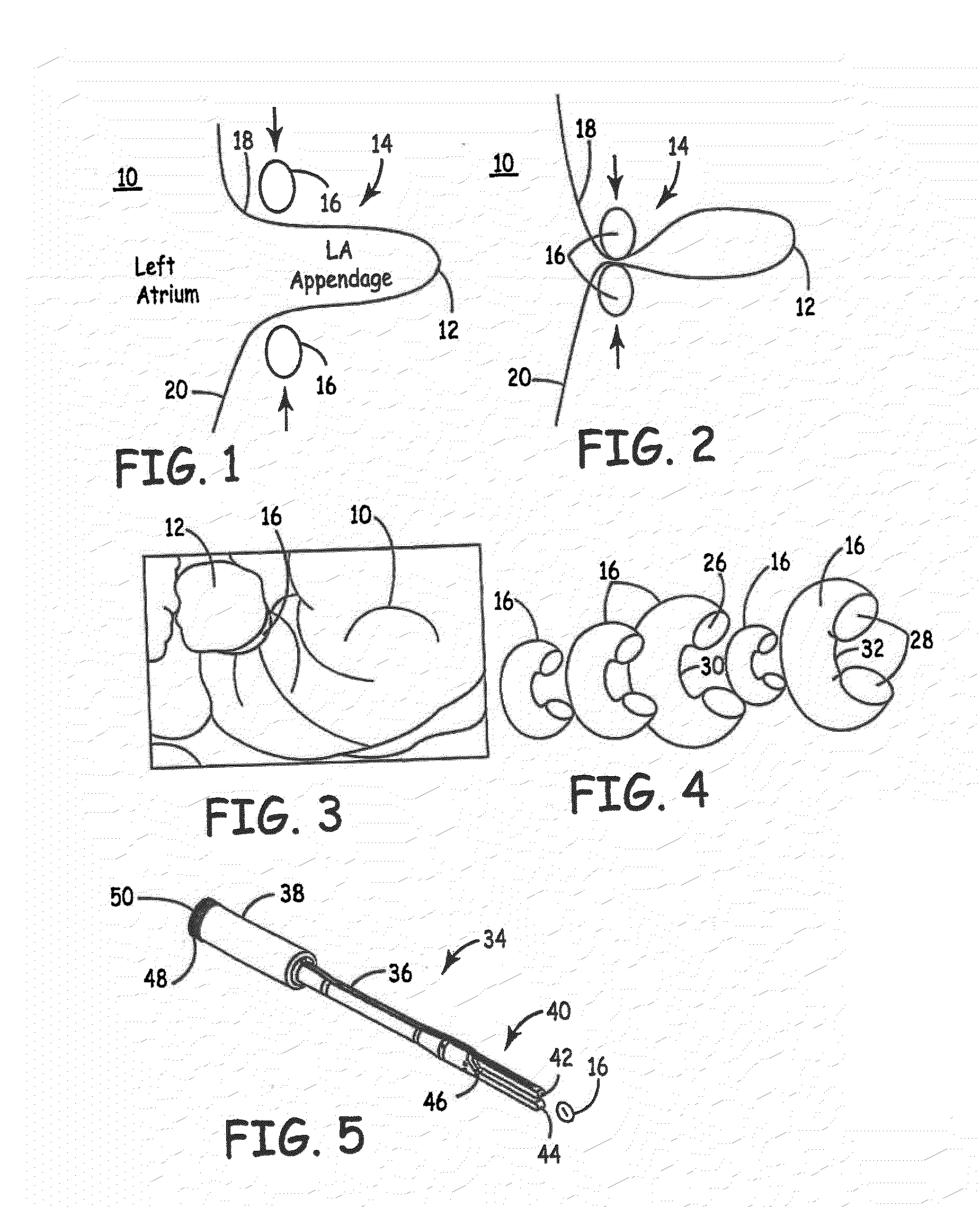 Methods and Devices for Occlusion of an Atrial Appendage