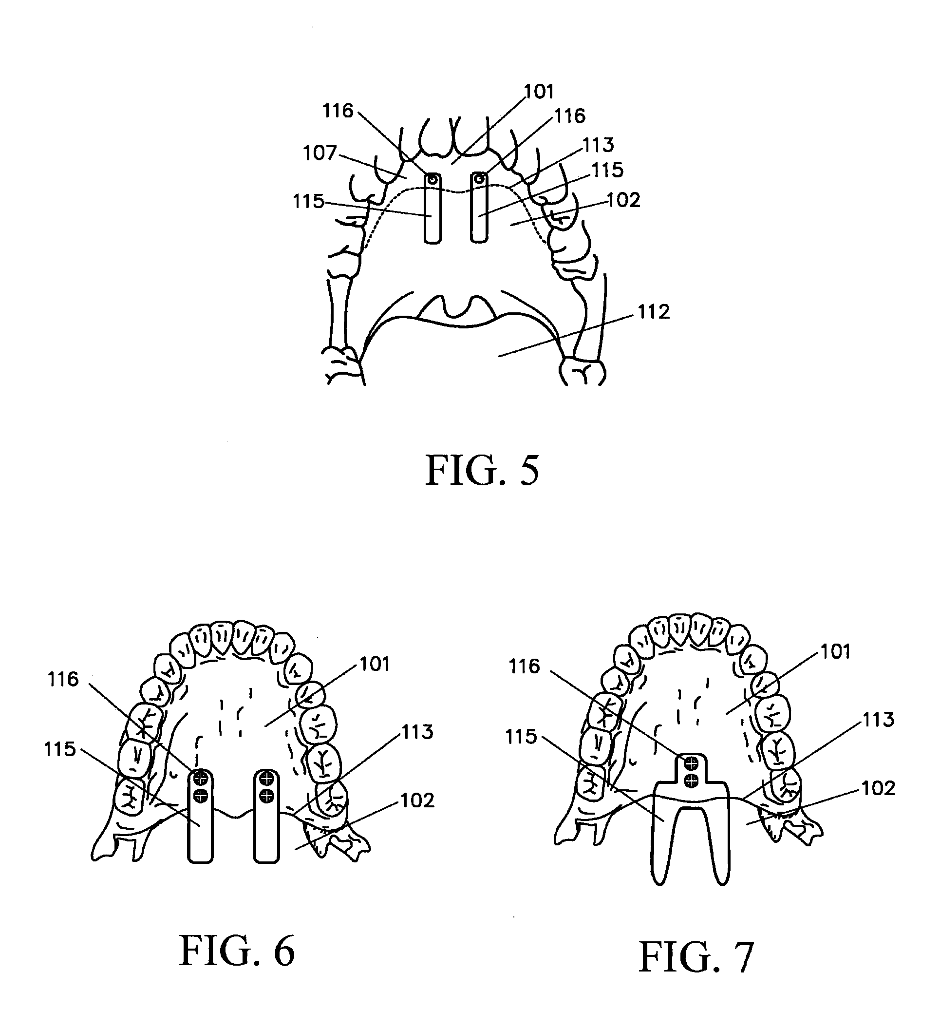 Implanted Soft Palate Support and Implantation Method