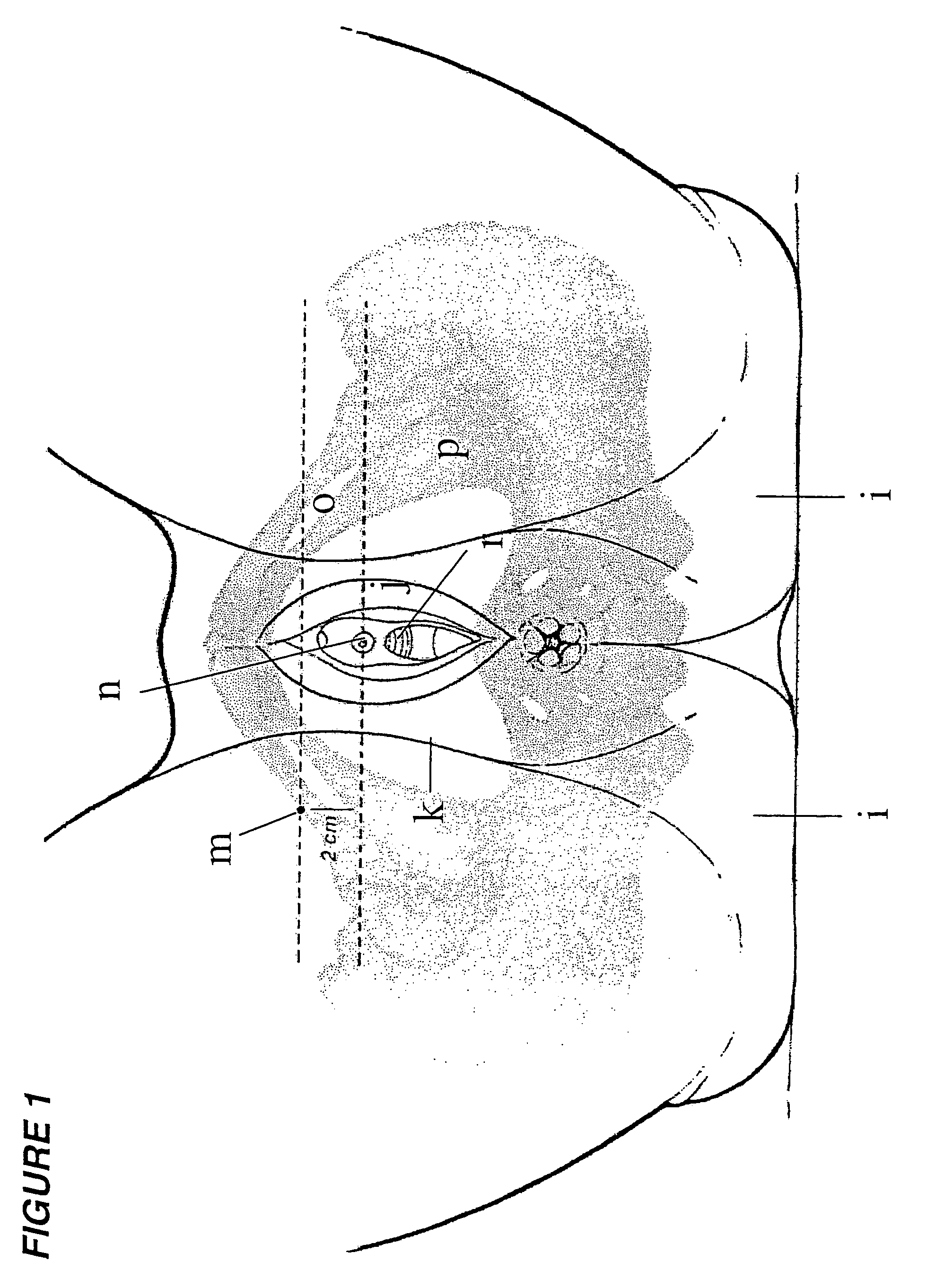 Surgical procedure for the treatment of female urinary incontinence: tension-free inside-out transobturator urethral suspension