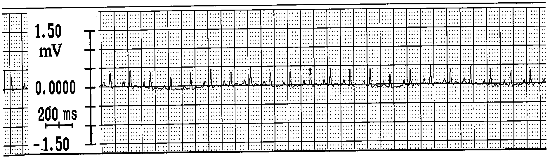 Preparation method of myocardial ischemia/reperfusion model in rats