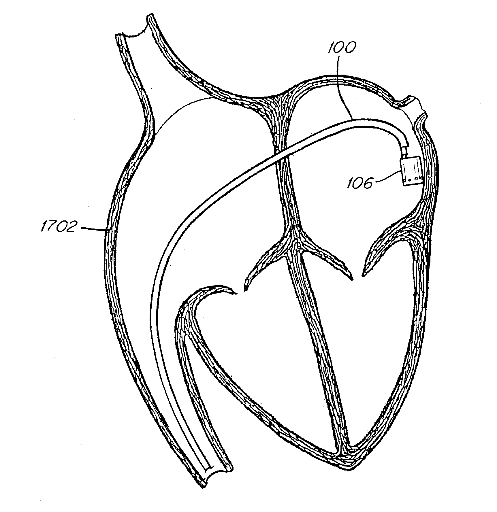 Irrigated catheter