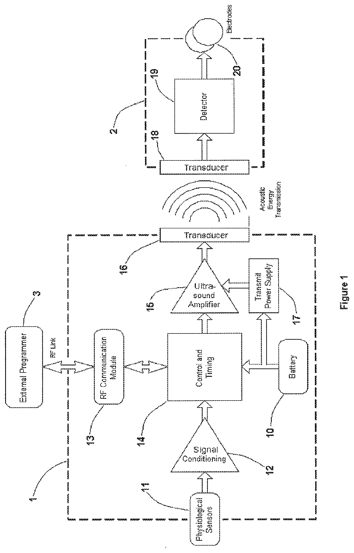 Methods and systems for heart failure prevention and treatments using ultrasound and leadless implantable devices