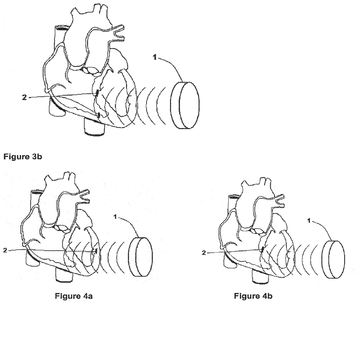 Methods and systems for heart failure prevention and treatments using ultrasound and leadless implantable devices