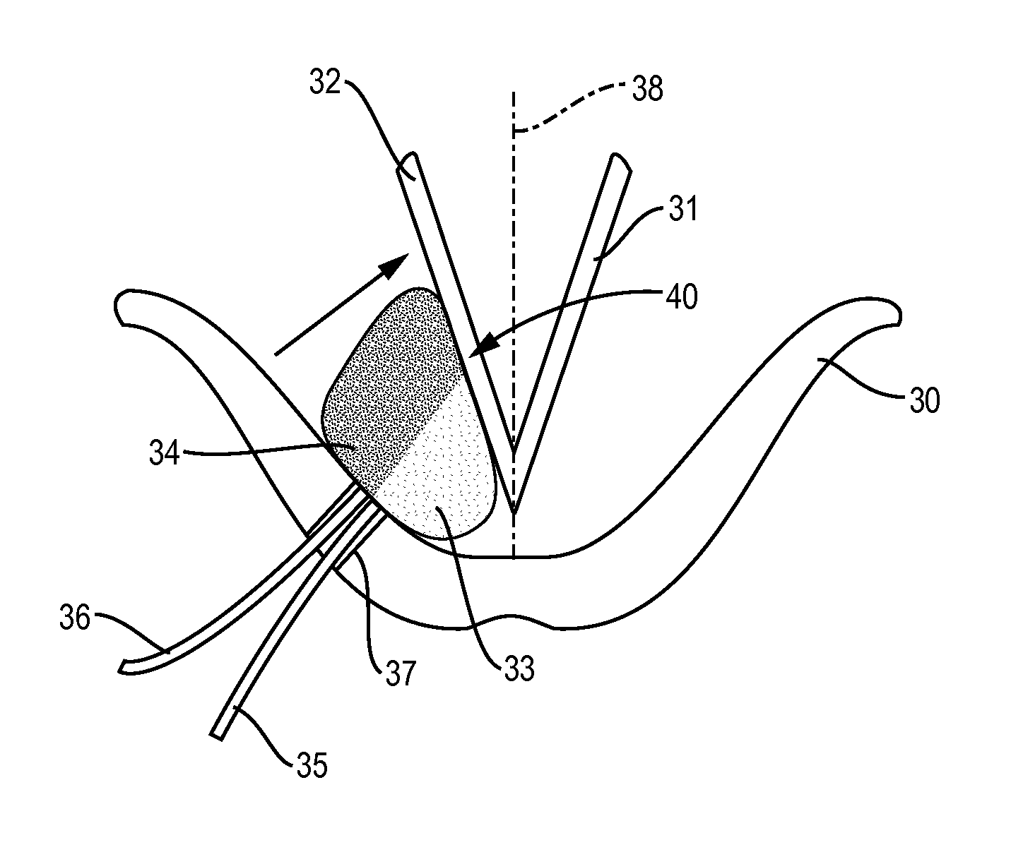 Stabilizing implant with expandable segments