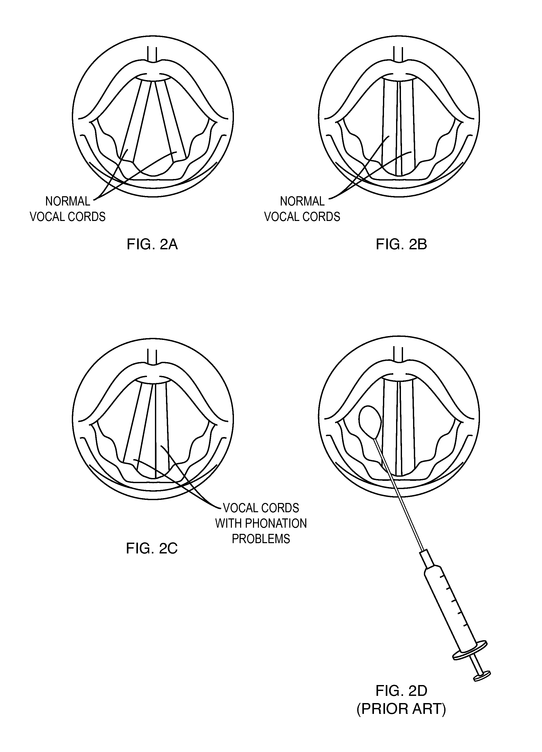 Stabilizing implant with expandable segments