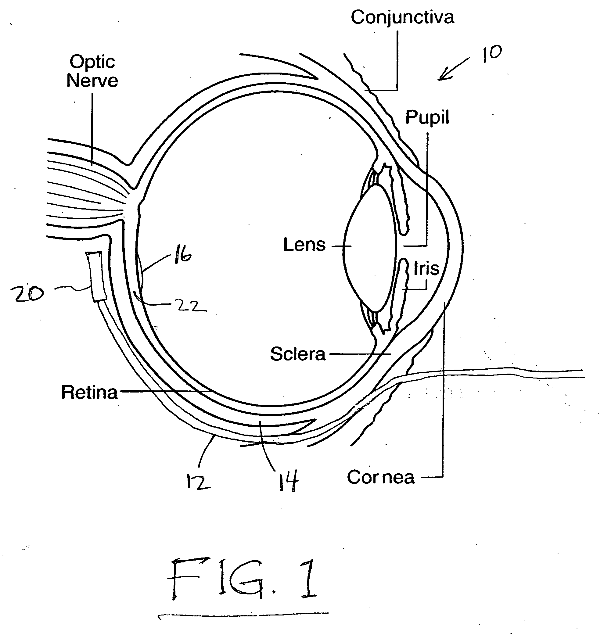 Treatment of age-related macular degeneration