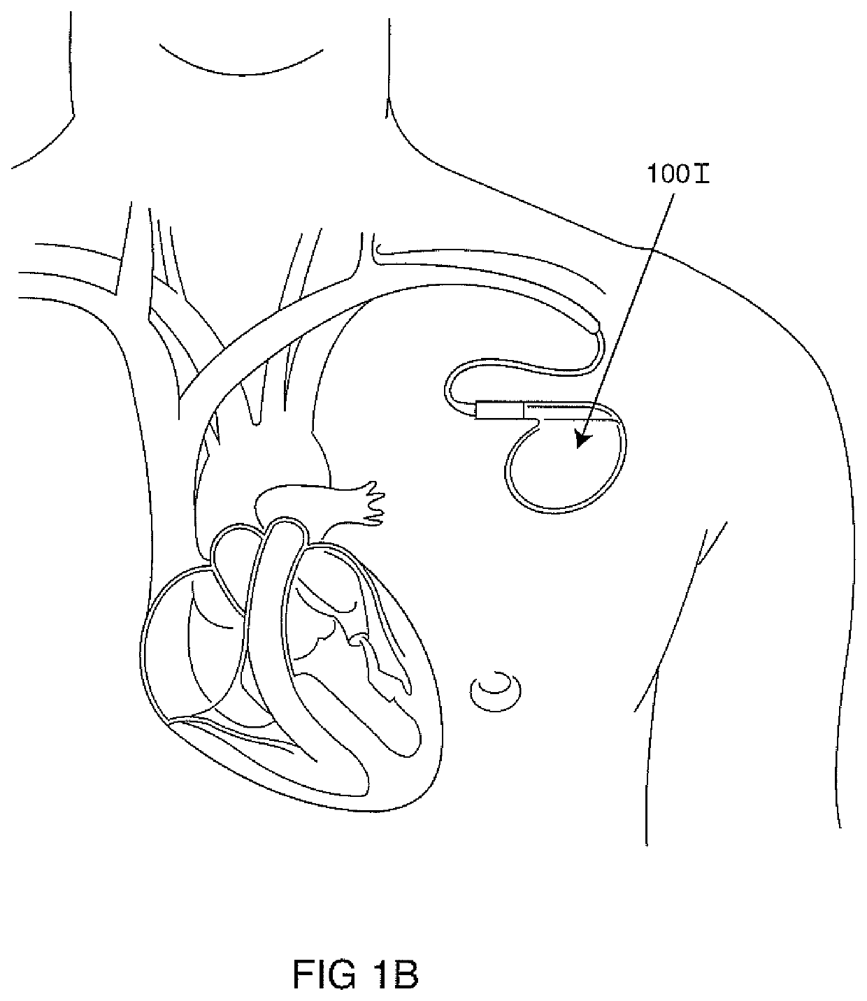 Triple Flip, Clinical Magnet Multiple Polarity And Placement Timed Sensing To Prevent Inadvertent Actuation Of Magnet-Mode In An Active Implantable Medical Device