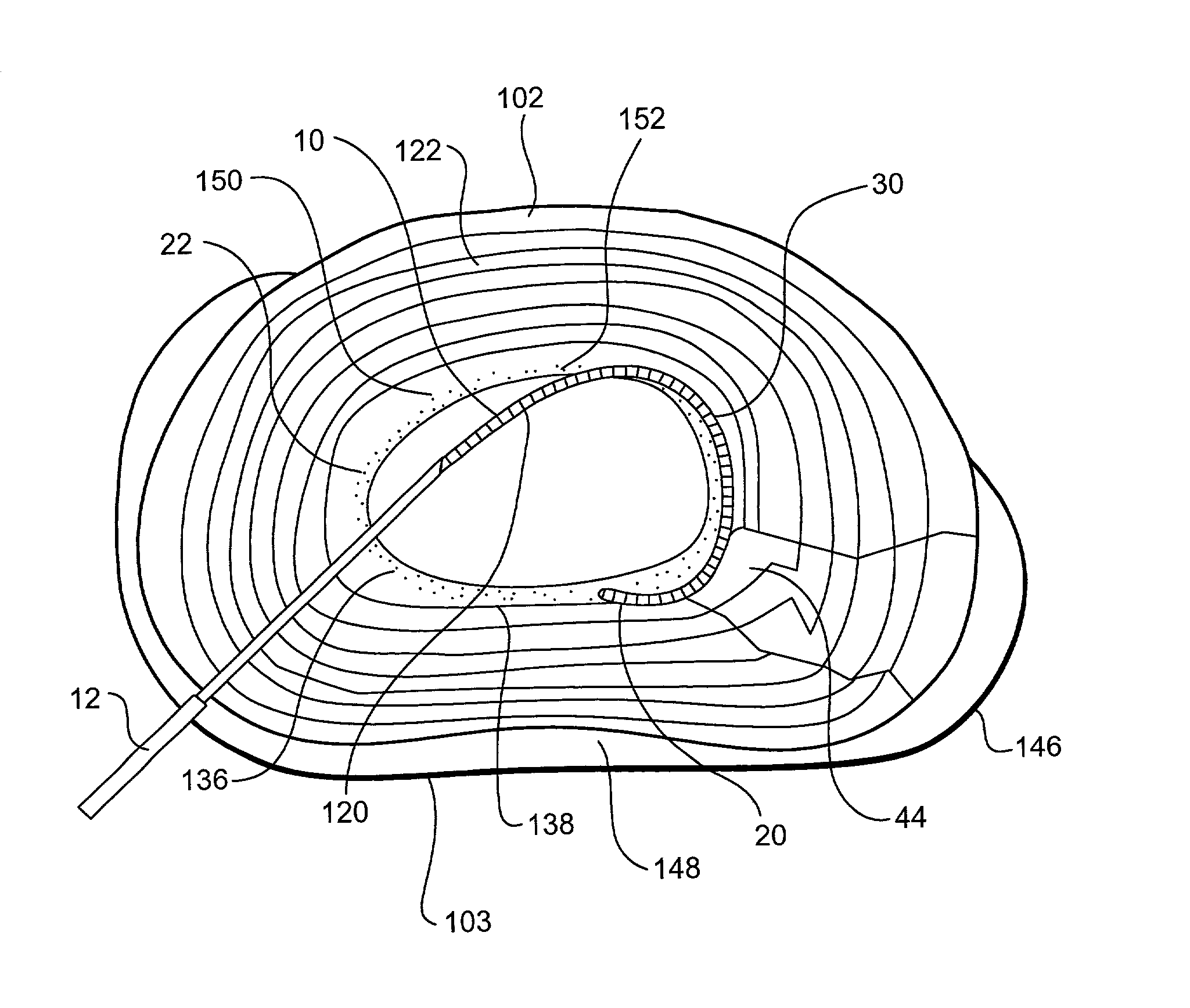 Apparatus and method for accessing and performing a function within an intervertebral disc