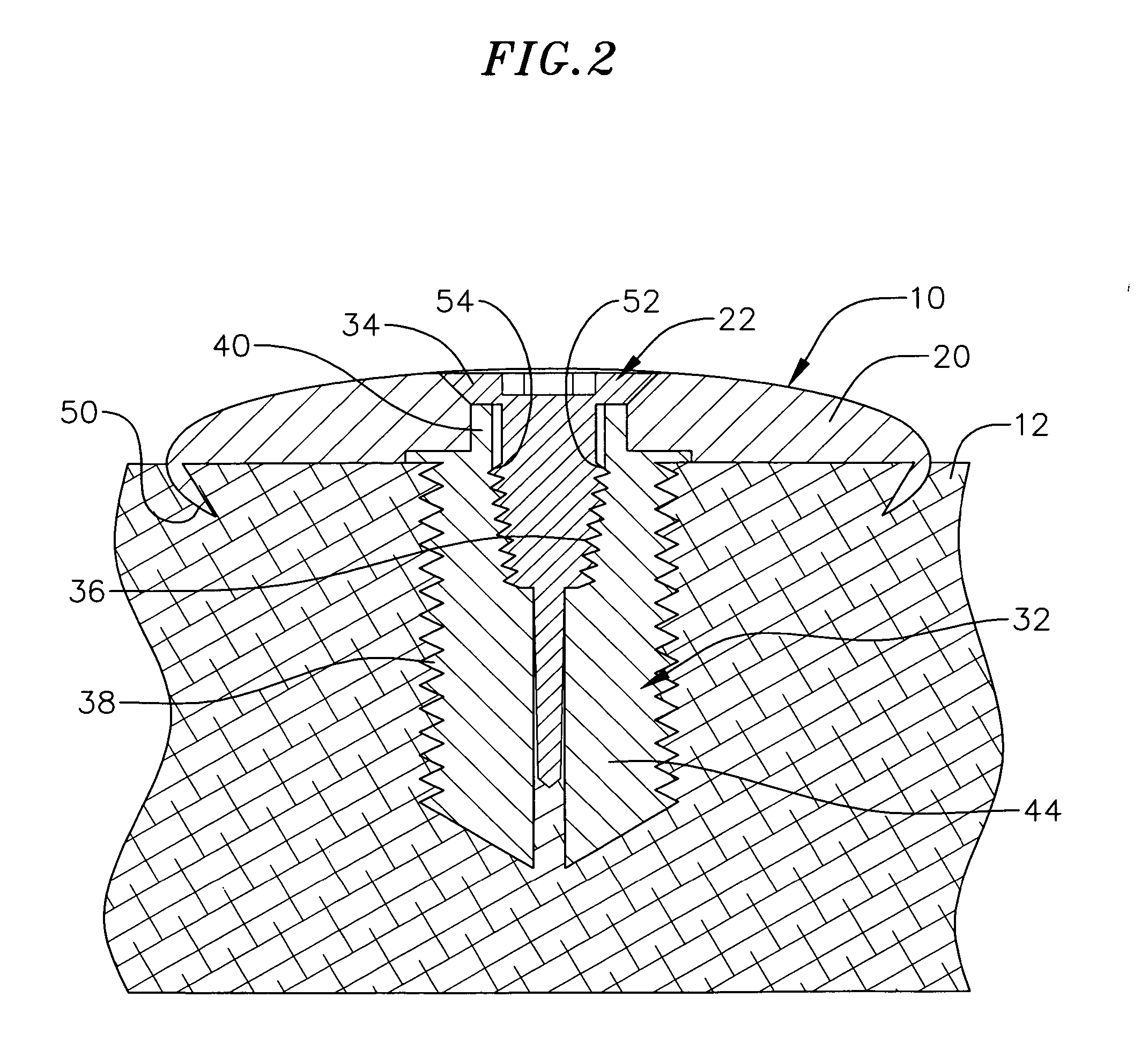 Spinal-column buttress plate assembly and method for attachment