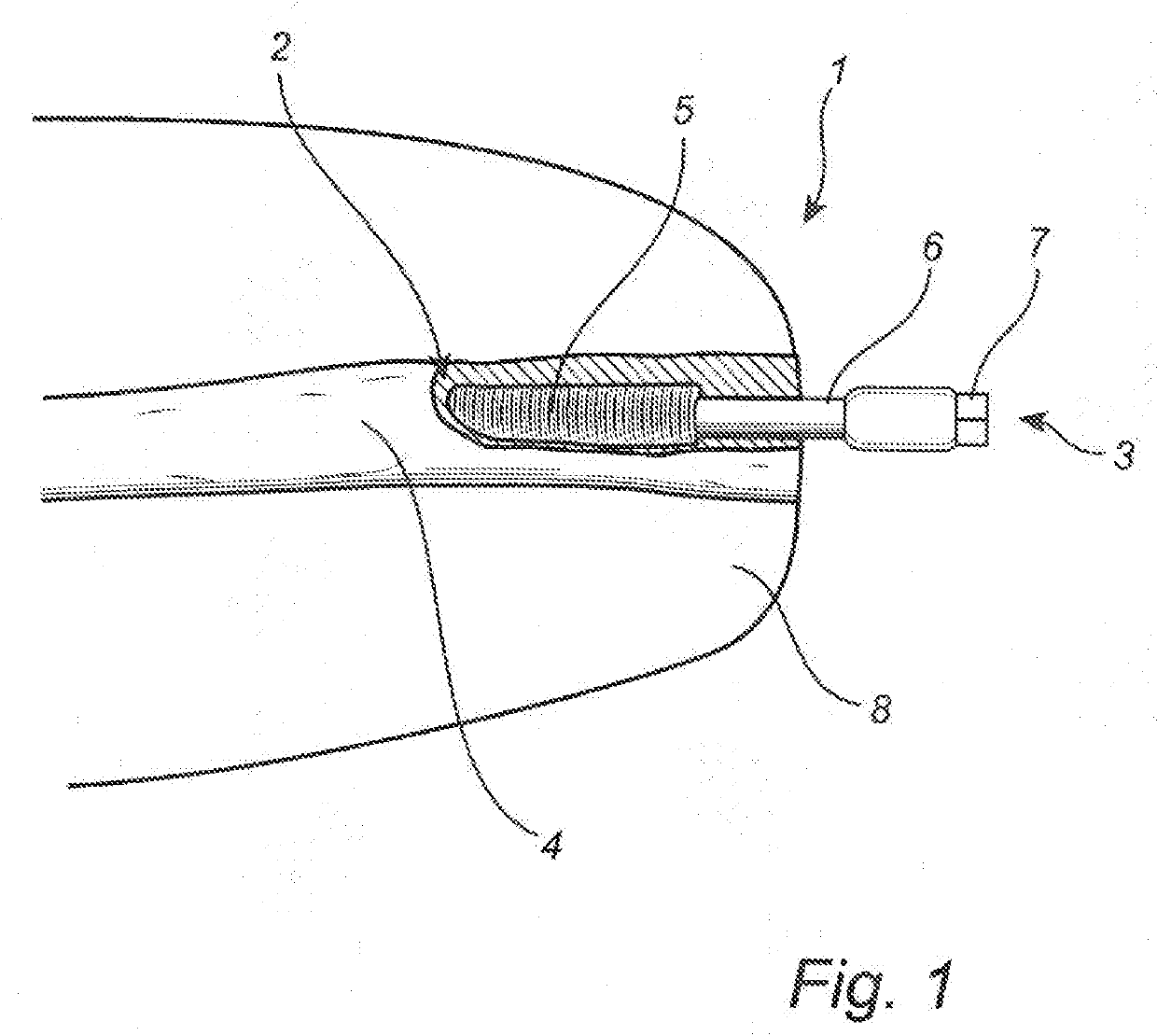 Anchoring system for attaching a prosthesis to a human body