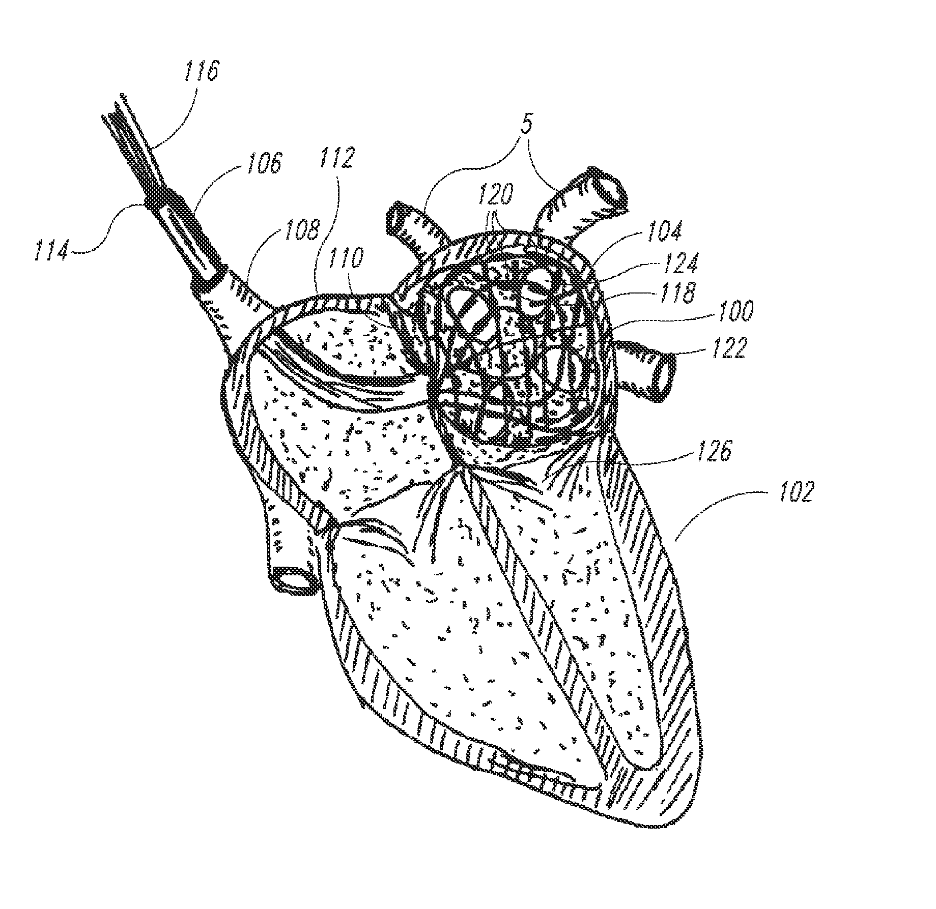 Medical device for use in bodily lumens, for example an atrium