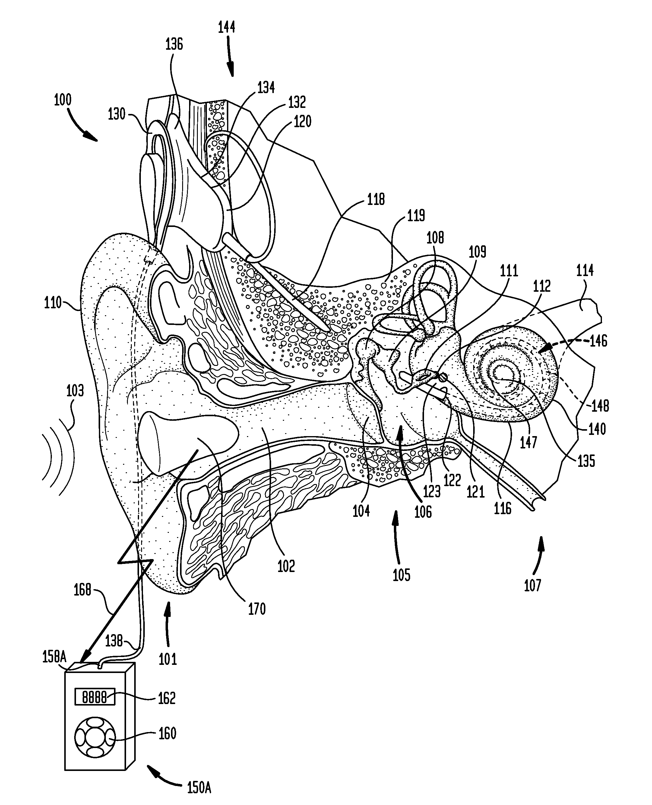 Wireless remote device for a hearing prosthesis