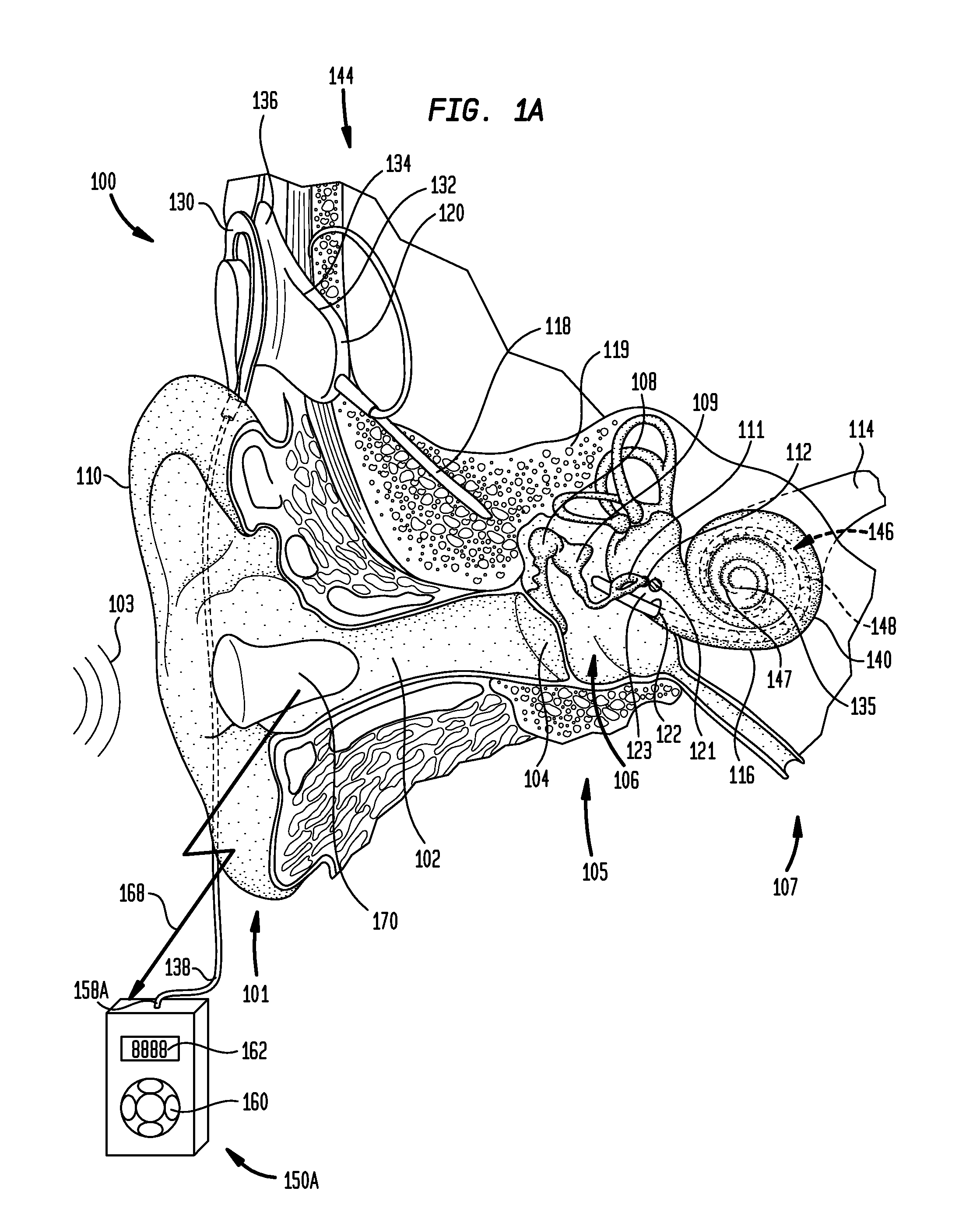 Wireless remote device for a hearing prosthesis