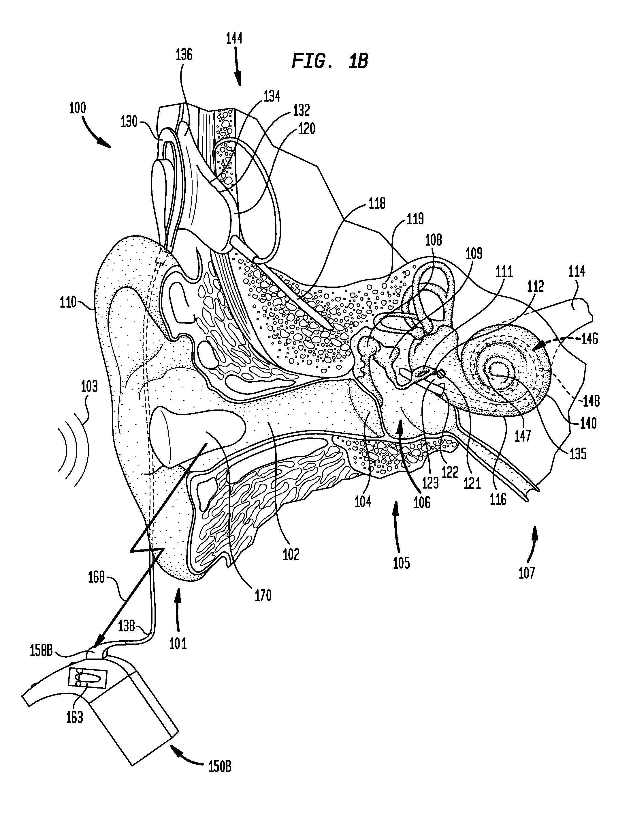 Wireless remote device for a hearing prosthesis