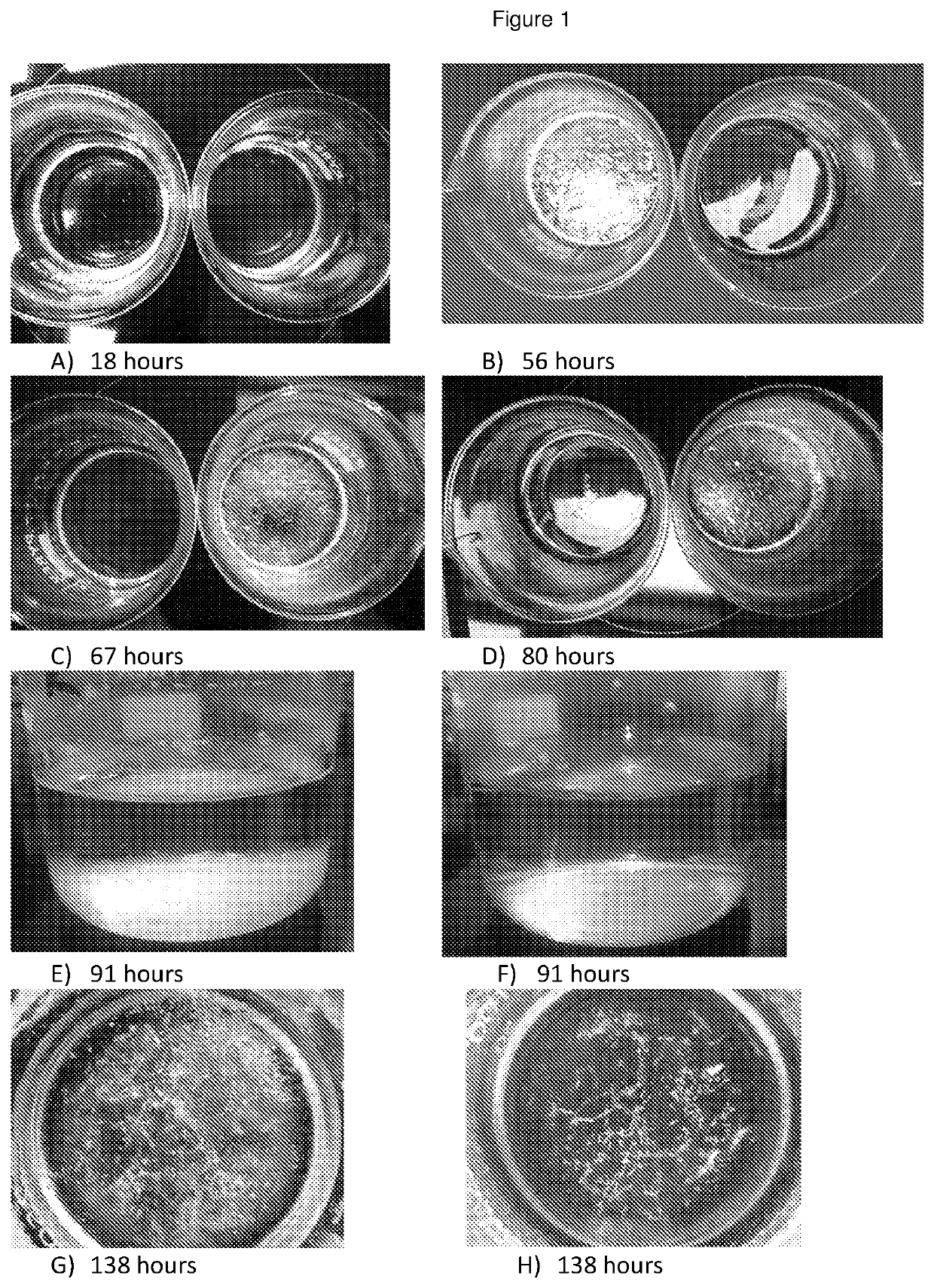 Treatment of cholesterol crystal formation