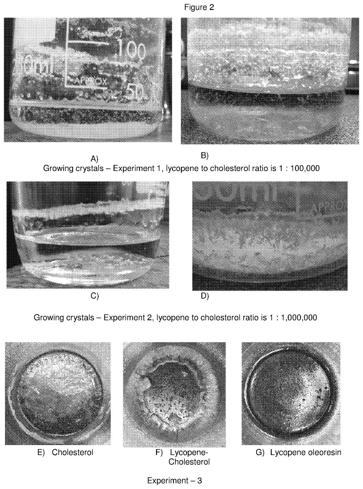 Treatment of cholesterol crystal formation