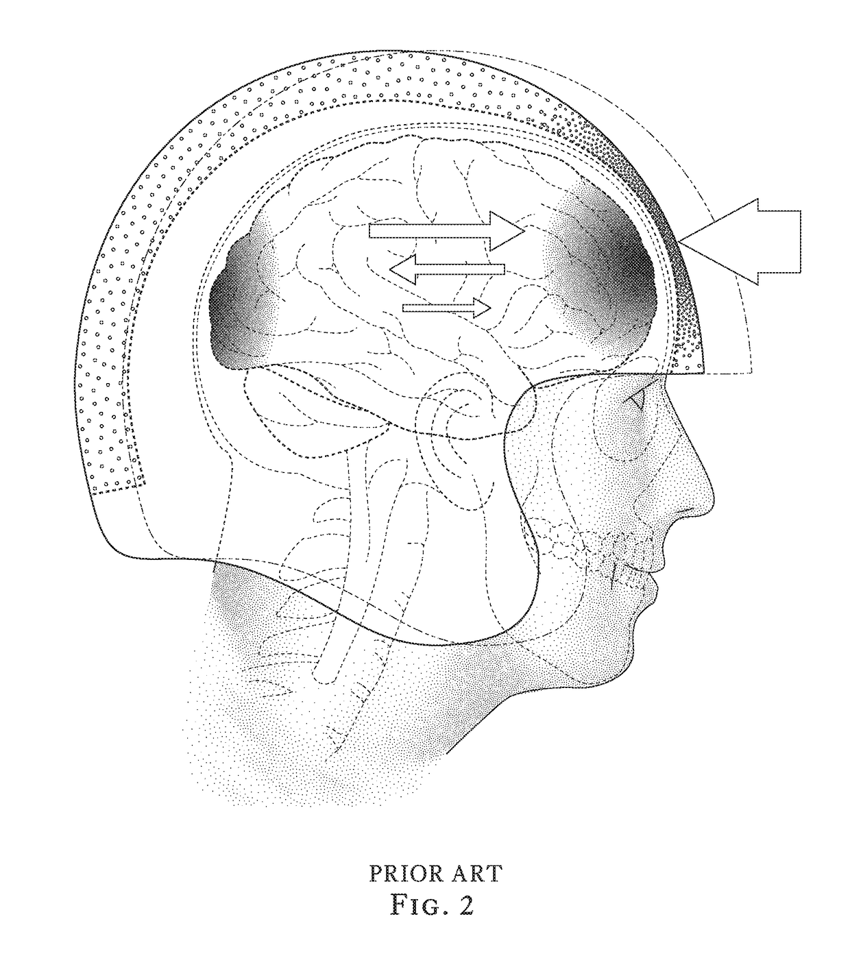 Brain-protecting helmet lining apparatus and method