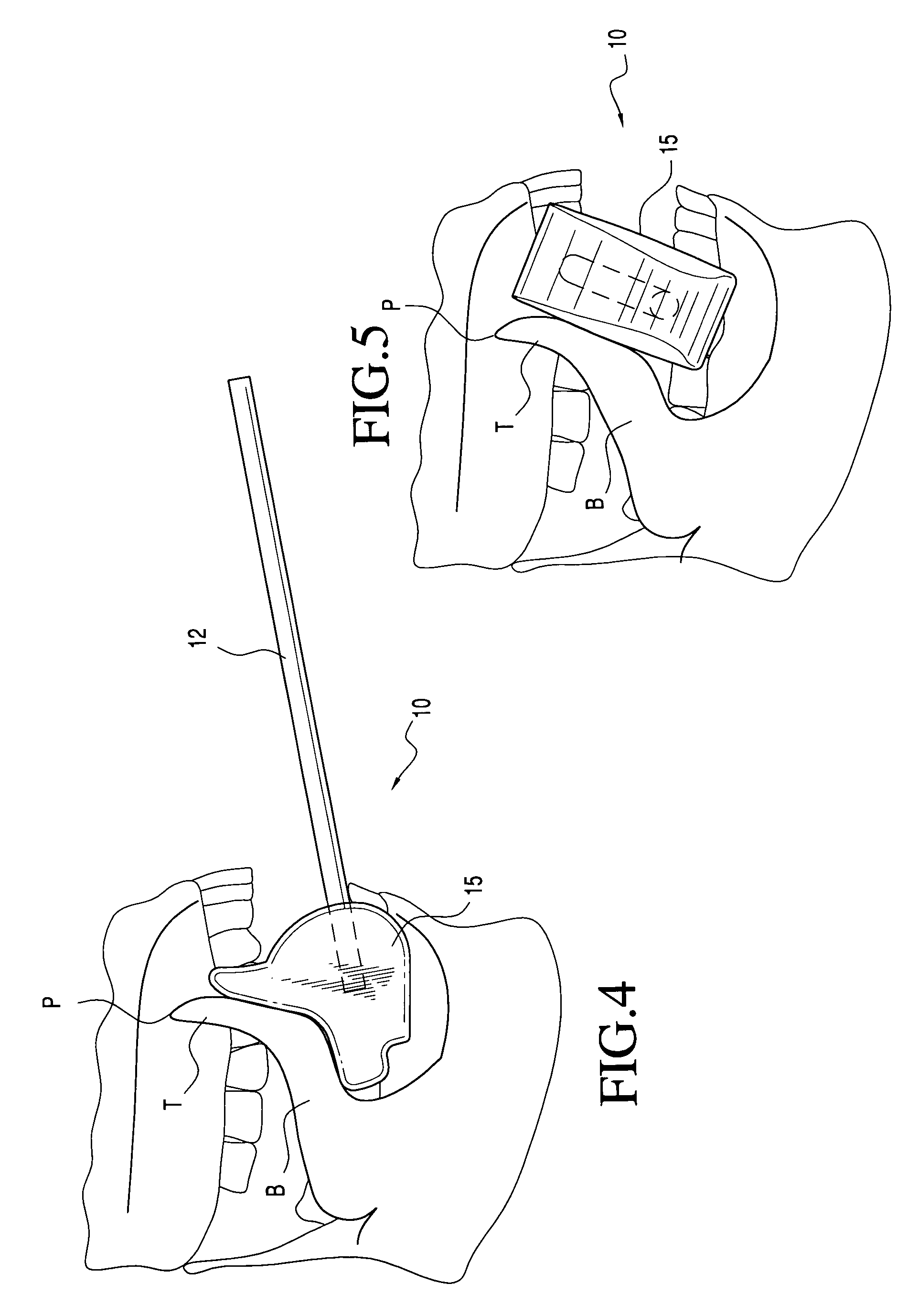 Implement for speech therapy