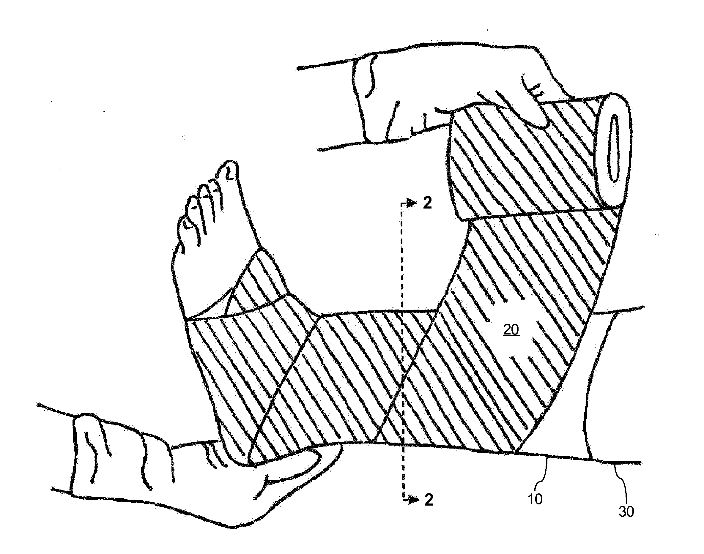 System and method for treating leg ulcers