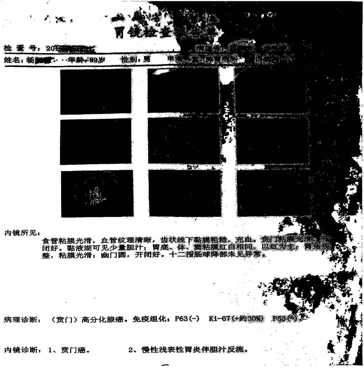 Traditional Chinese medicine composition for treating gastric carcinoma, and preparation method of traditional Chinese medicine composition