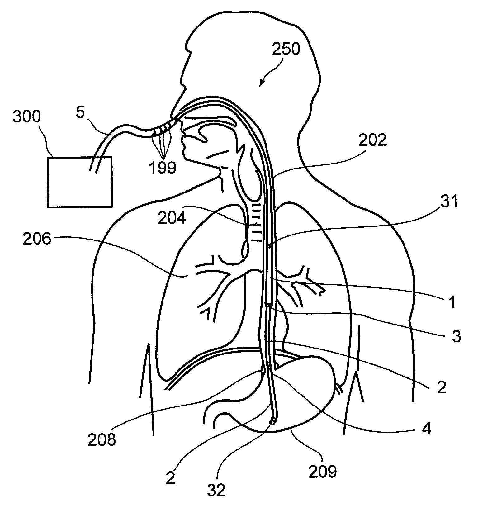 Interactive NGT system