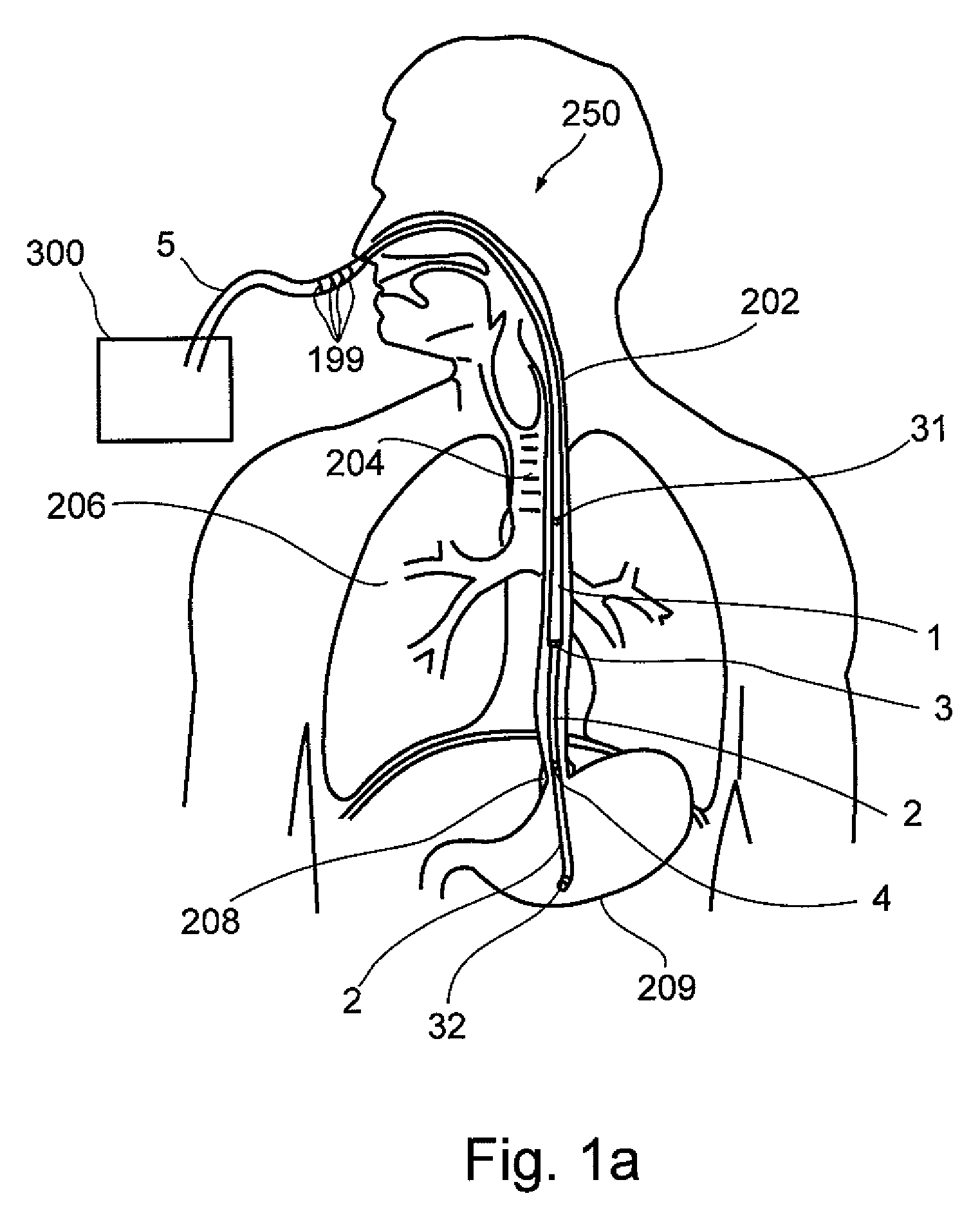 Interactive NGT system