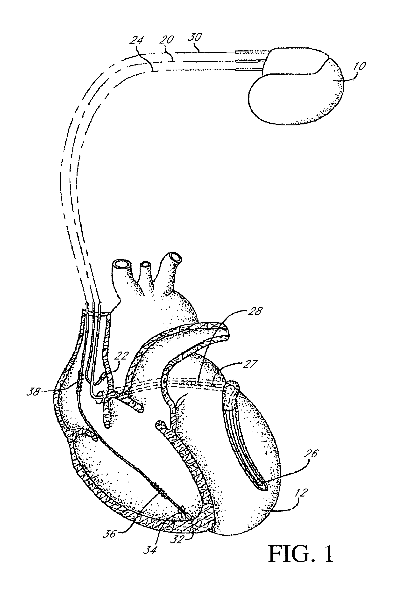 Implantable cardiac stimulation device with respiratory modulated therapy delivery