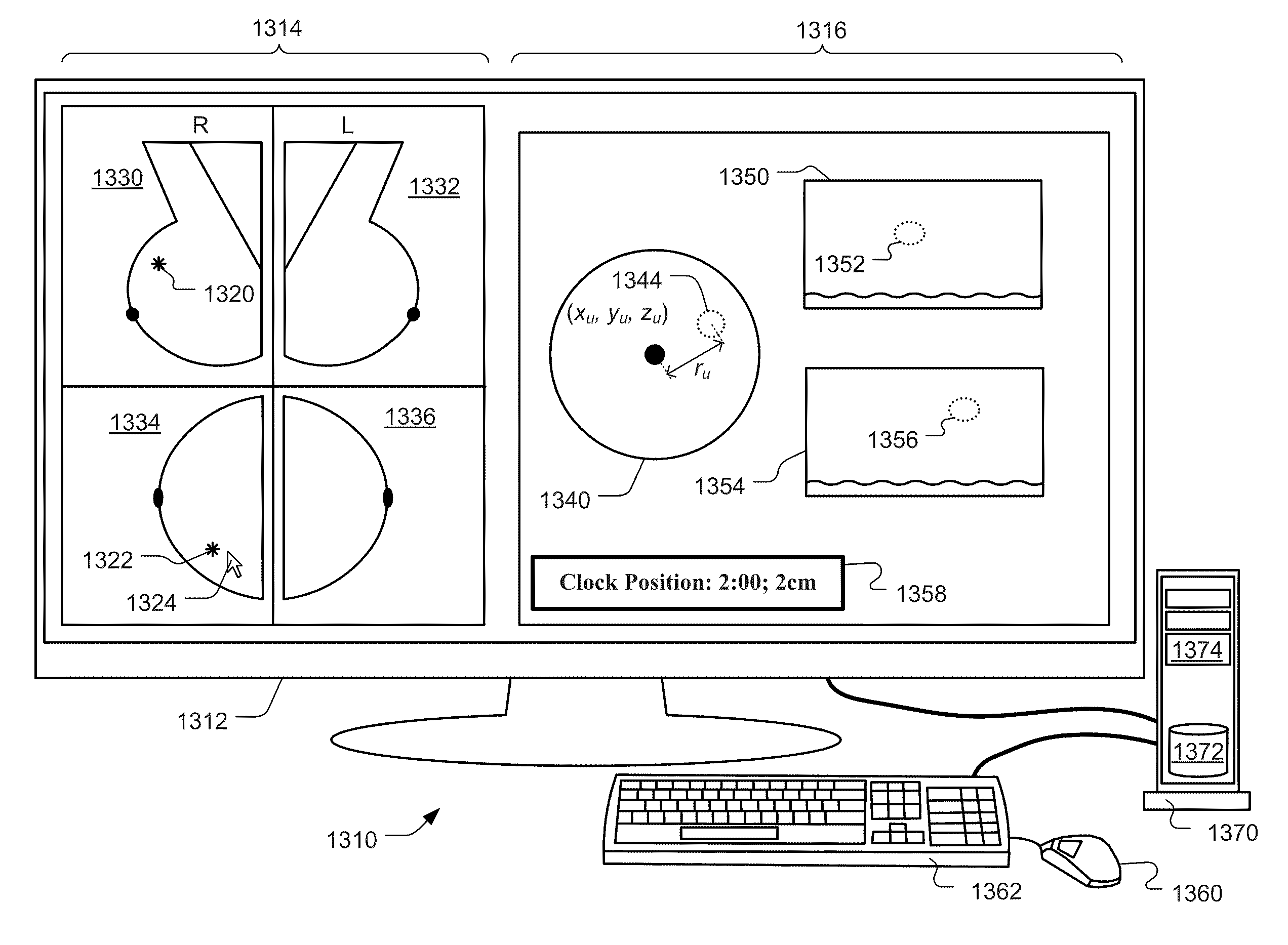 Computer Aided Detection Of Abnormalities In Volumetric Breast Ultrasound Scans And User Interface