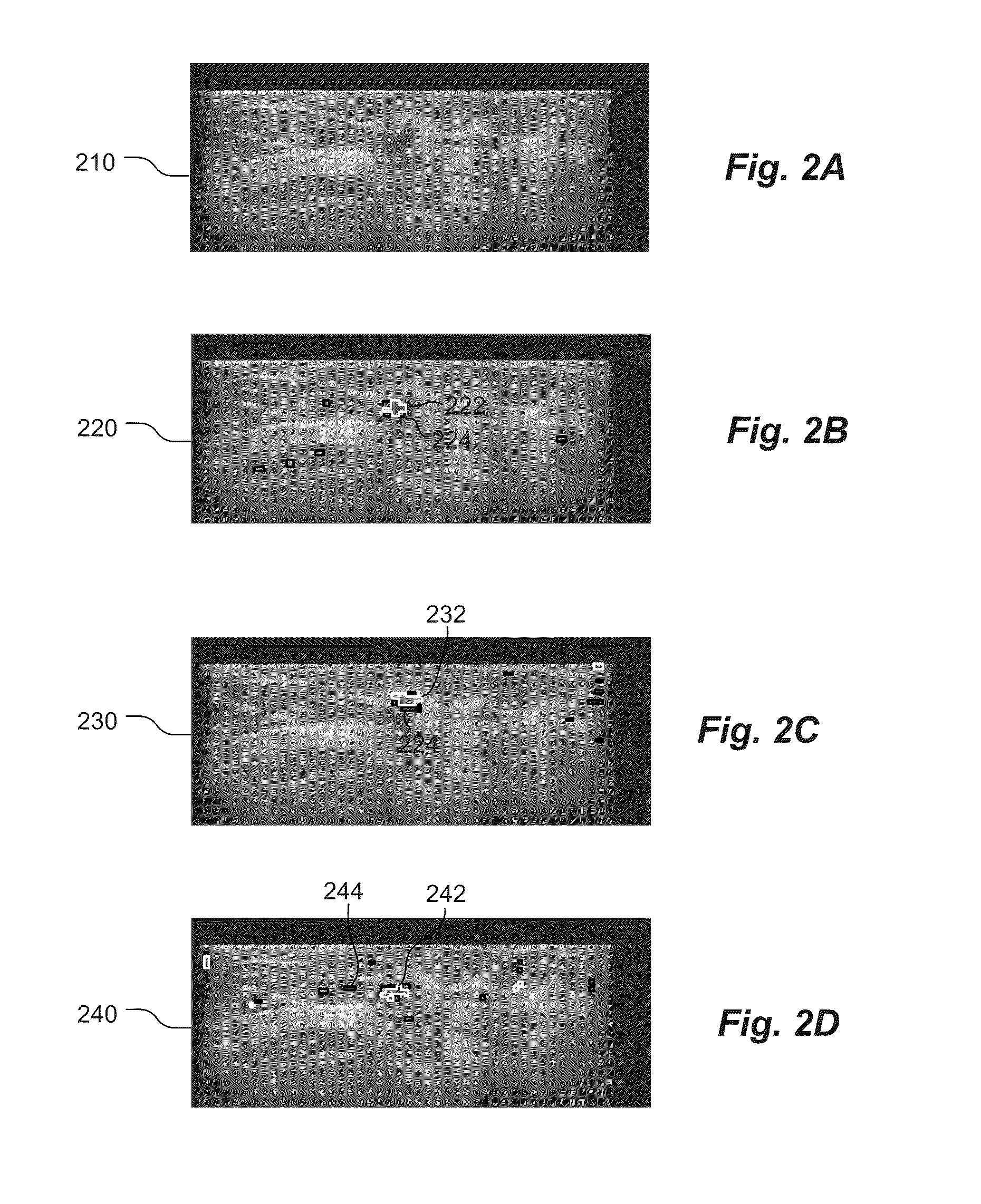 Computer Aided Detection Of Abnormalities In Volumetric Breast Ultrasound Scans And User Interface