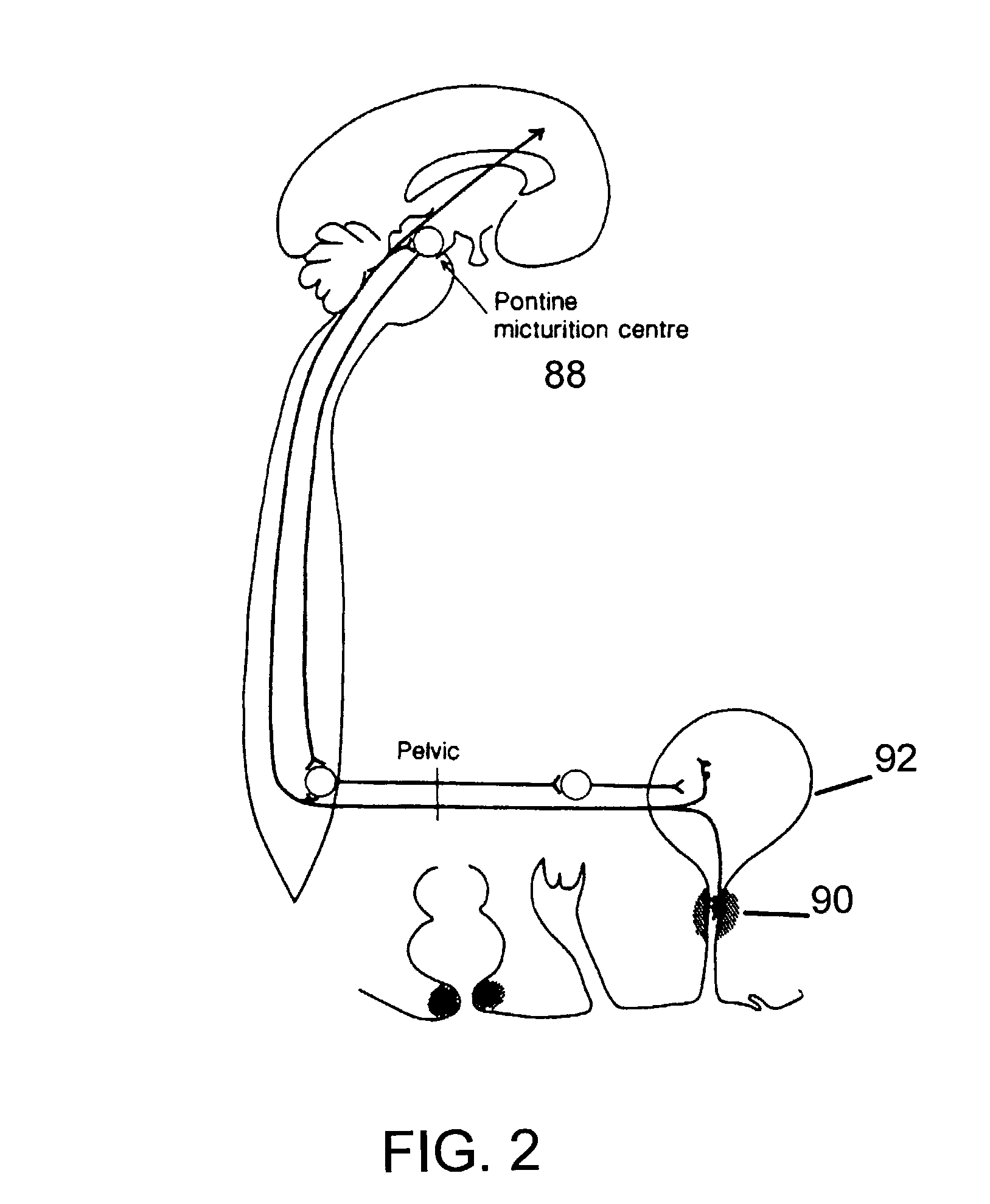 Electrical stimulation adjunct (Add-ON) therapy for urinary incontinence and urological disorders using implanted lead stimulus-receiver and an external pulse generator