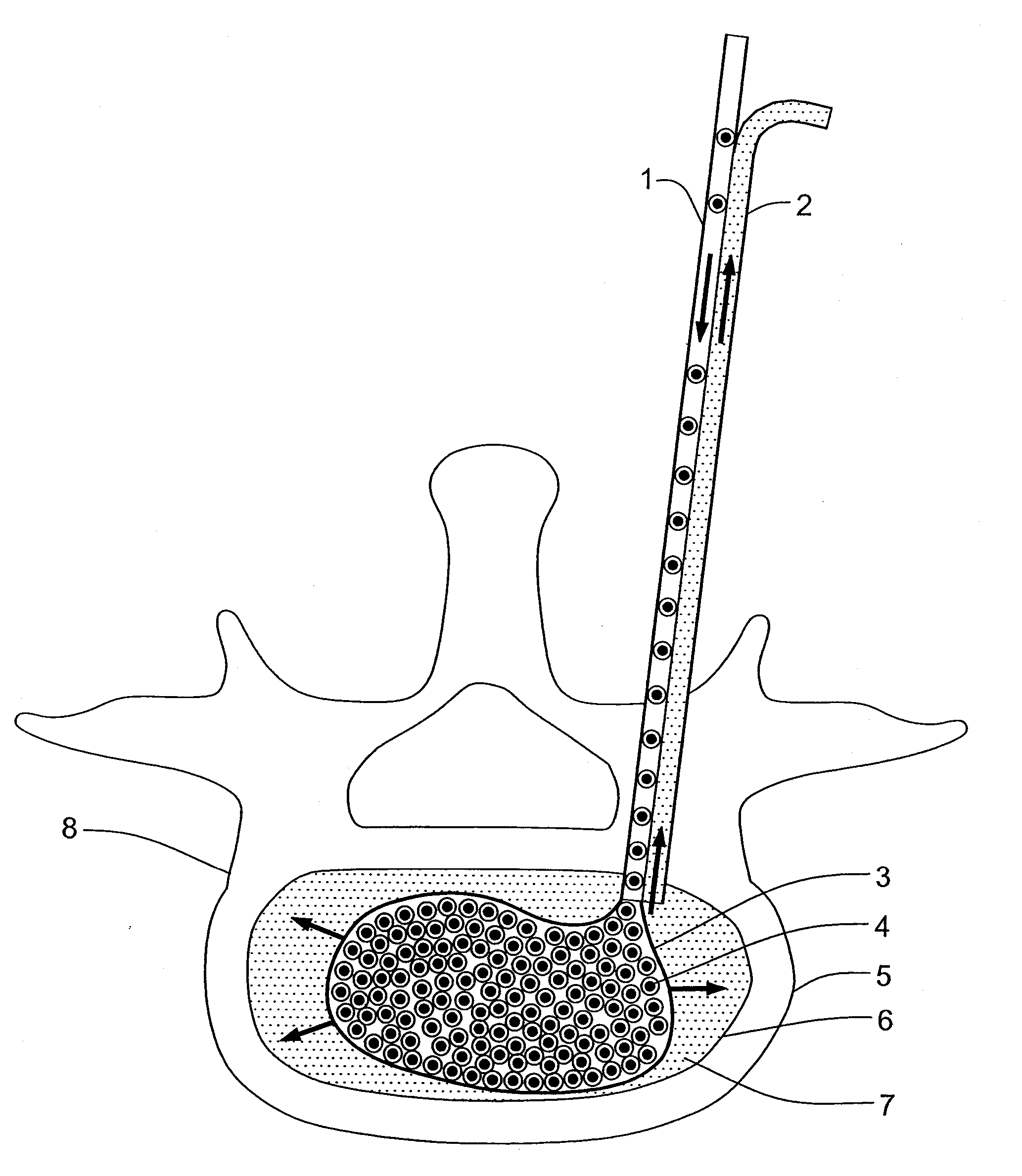 Method and device for reducing susceptibility to fractures in vertebral bodies