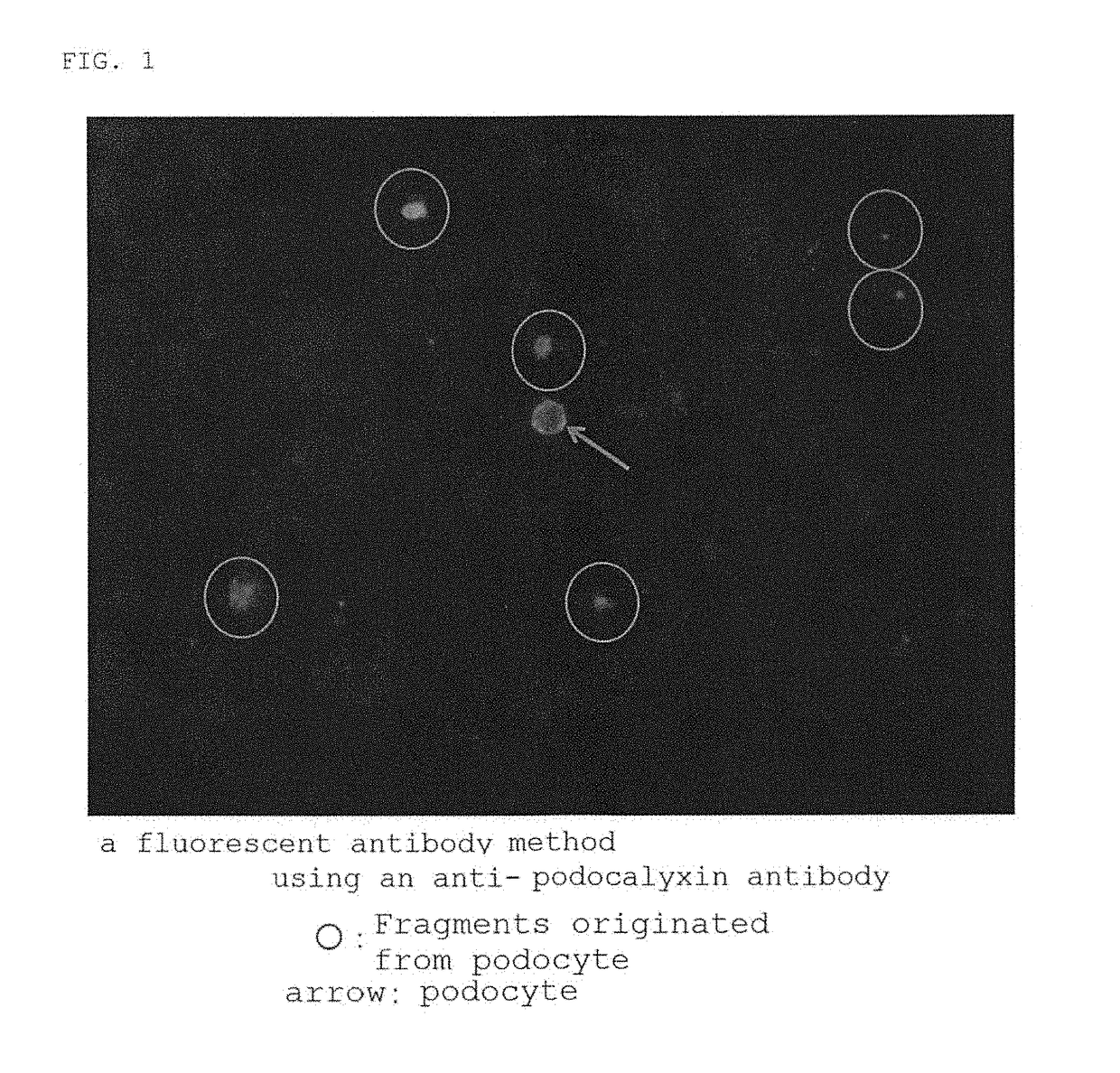 Method for estimating number of podocytes in urine