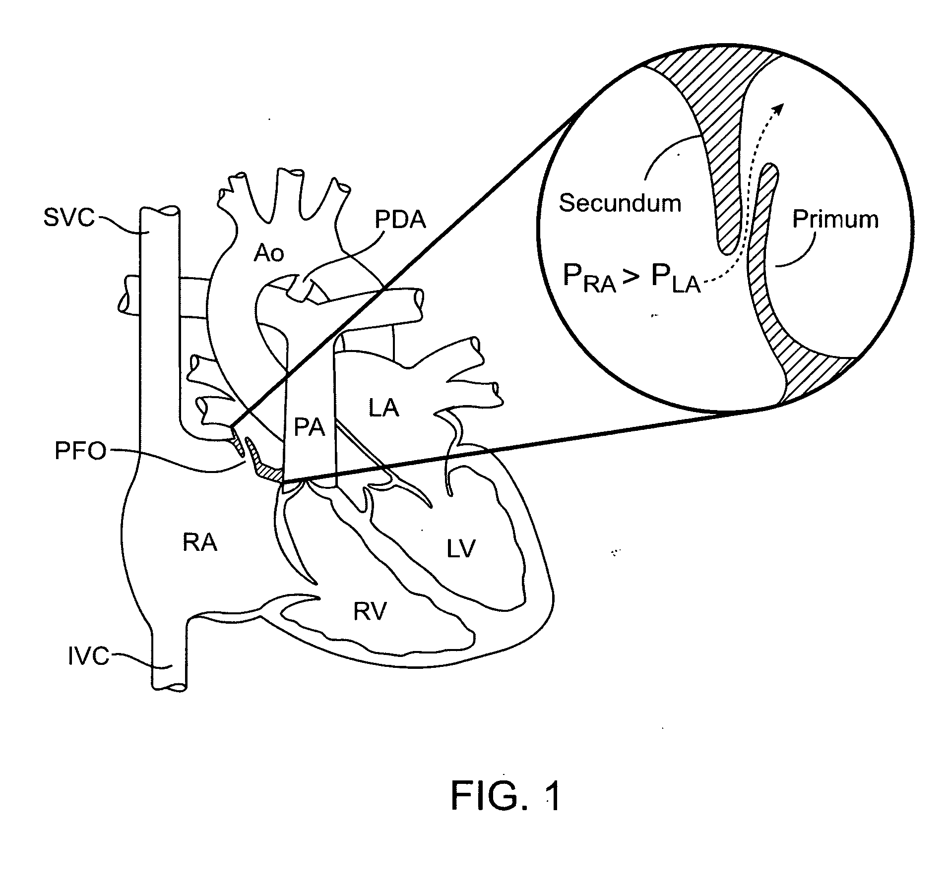 Methods and apparatus to achieve a closure of a layered tissue defect