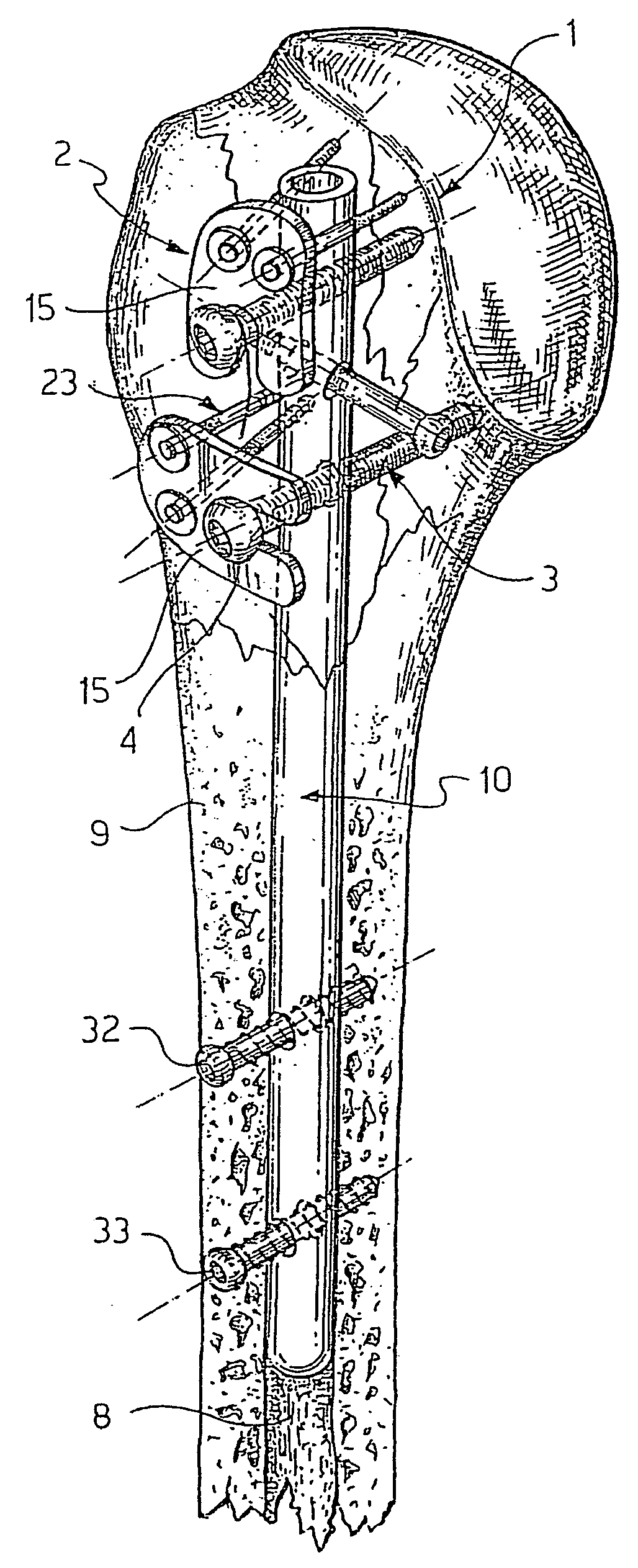 System for fixation of bone fractures