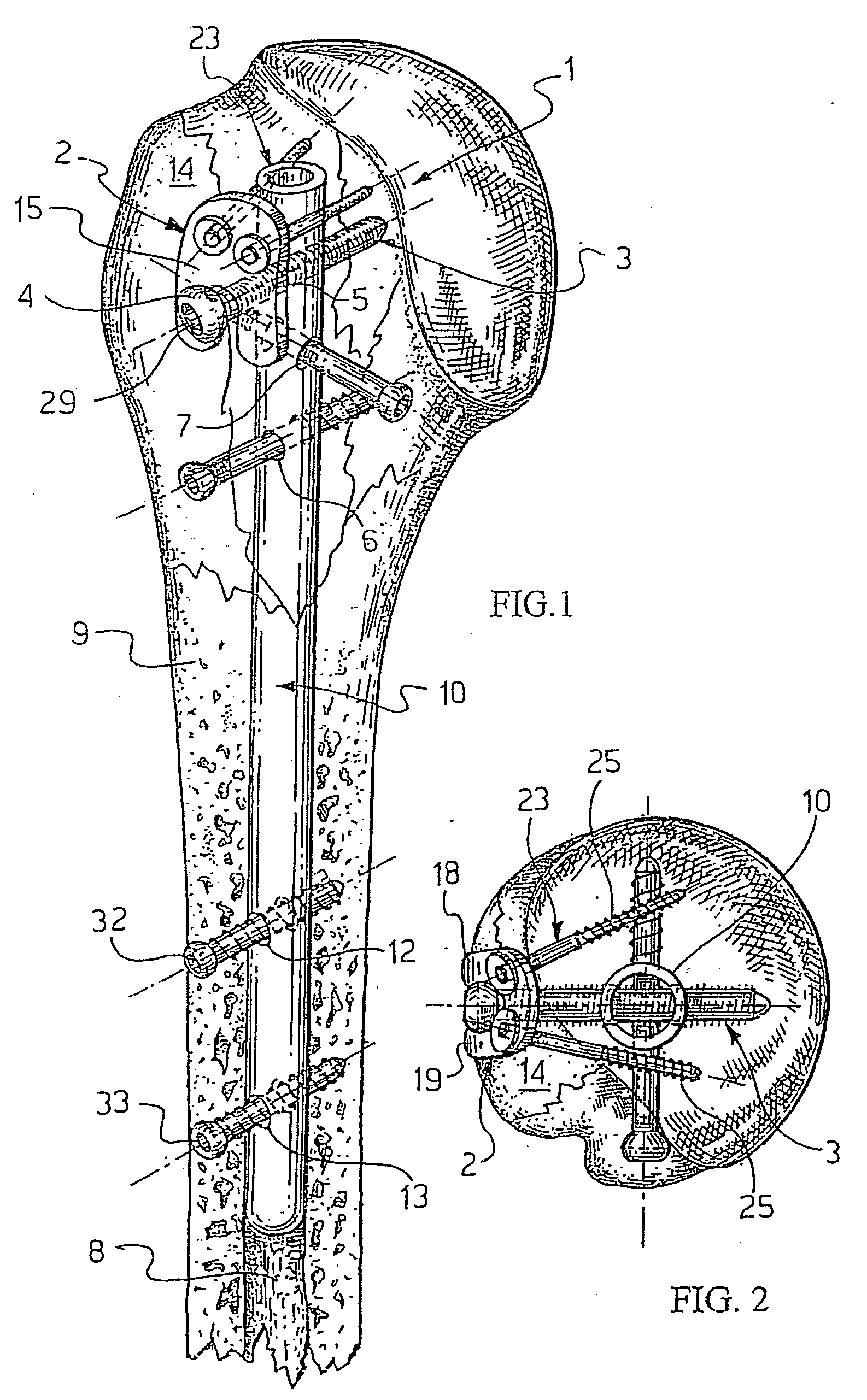 System for fixation of bone fractures