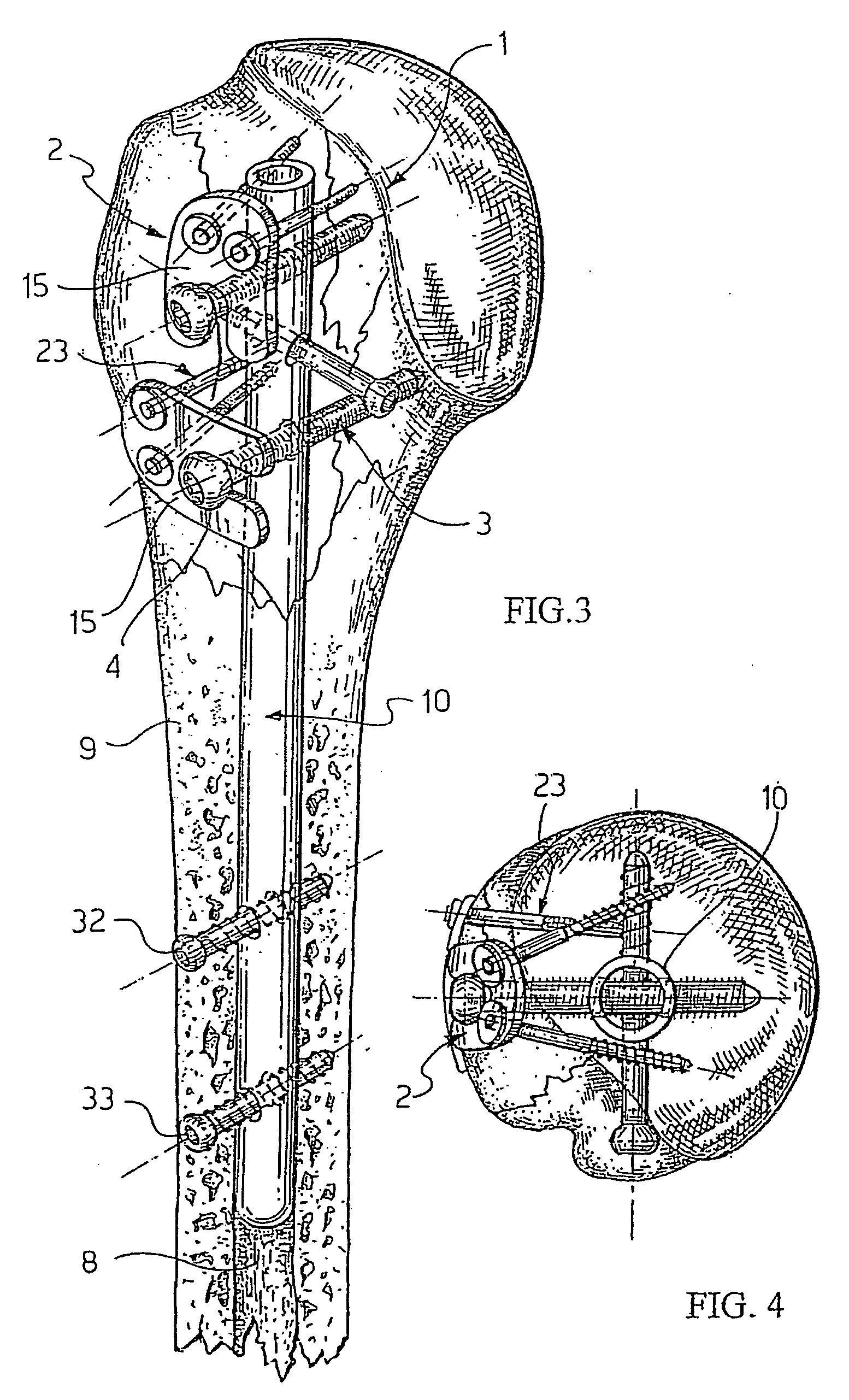 System for fixation of bone fractures