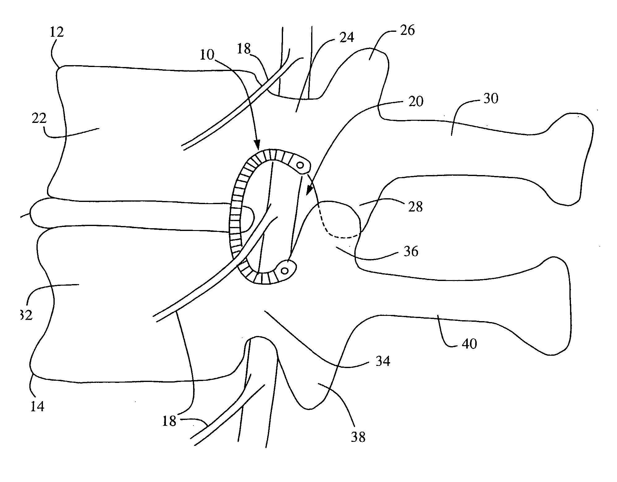 Systems and Methods for Direct Restoration of Foraminal Volume