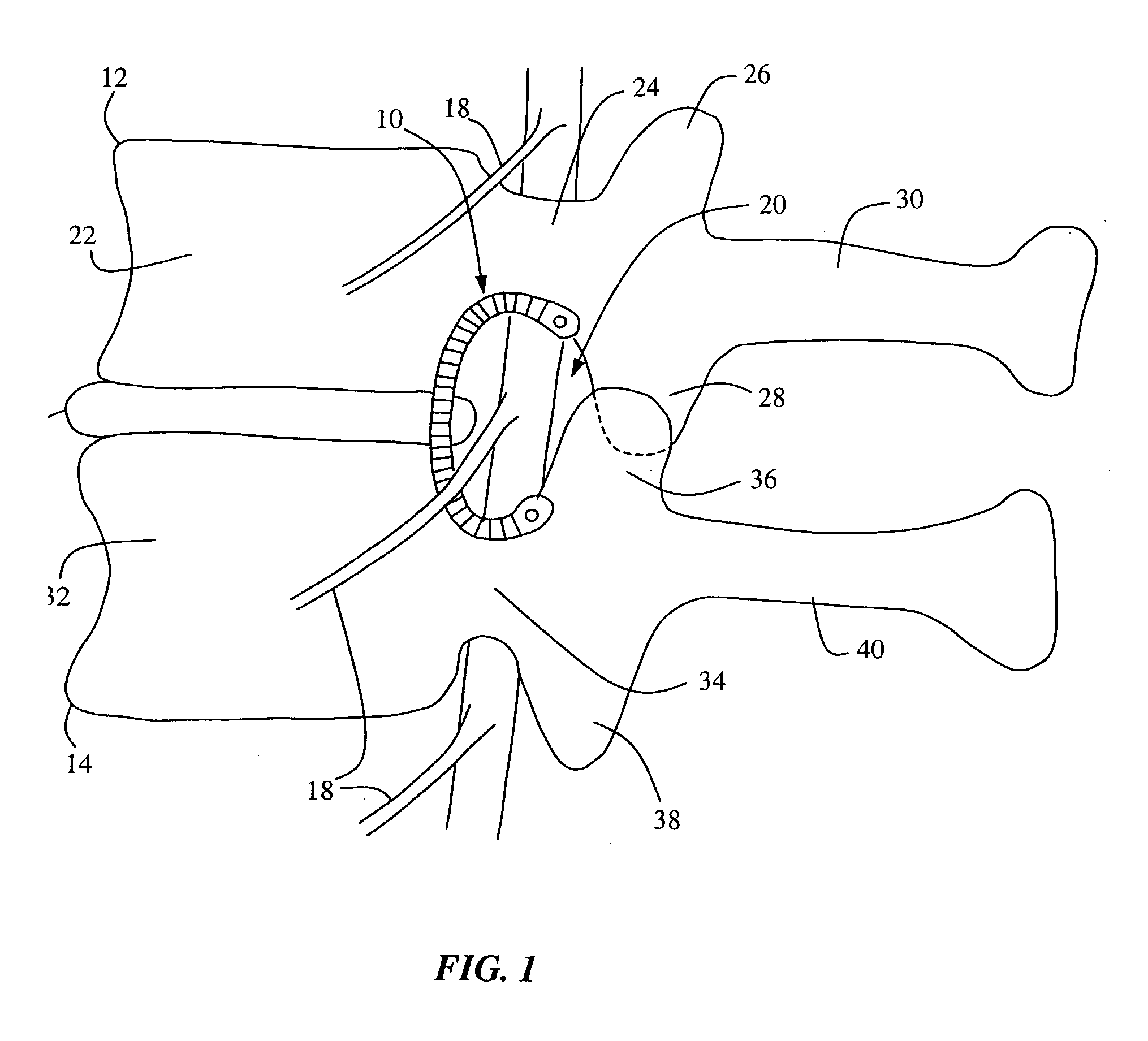 Systems and Methods for Direct Restoration of Foraminal Volume