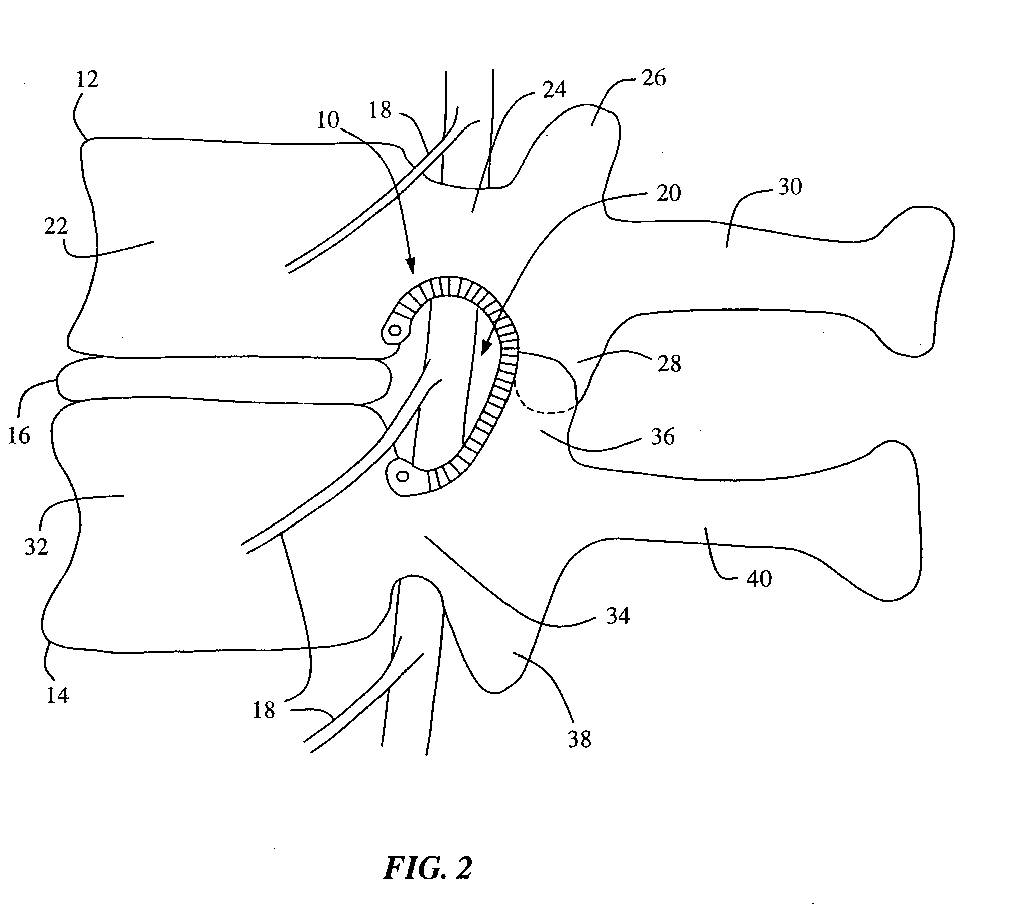 Systems and Methods for Direct Restoration of Foraminal Volume