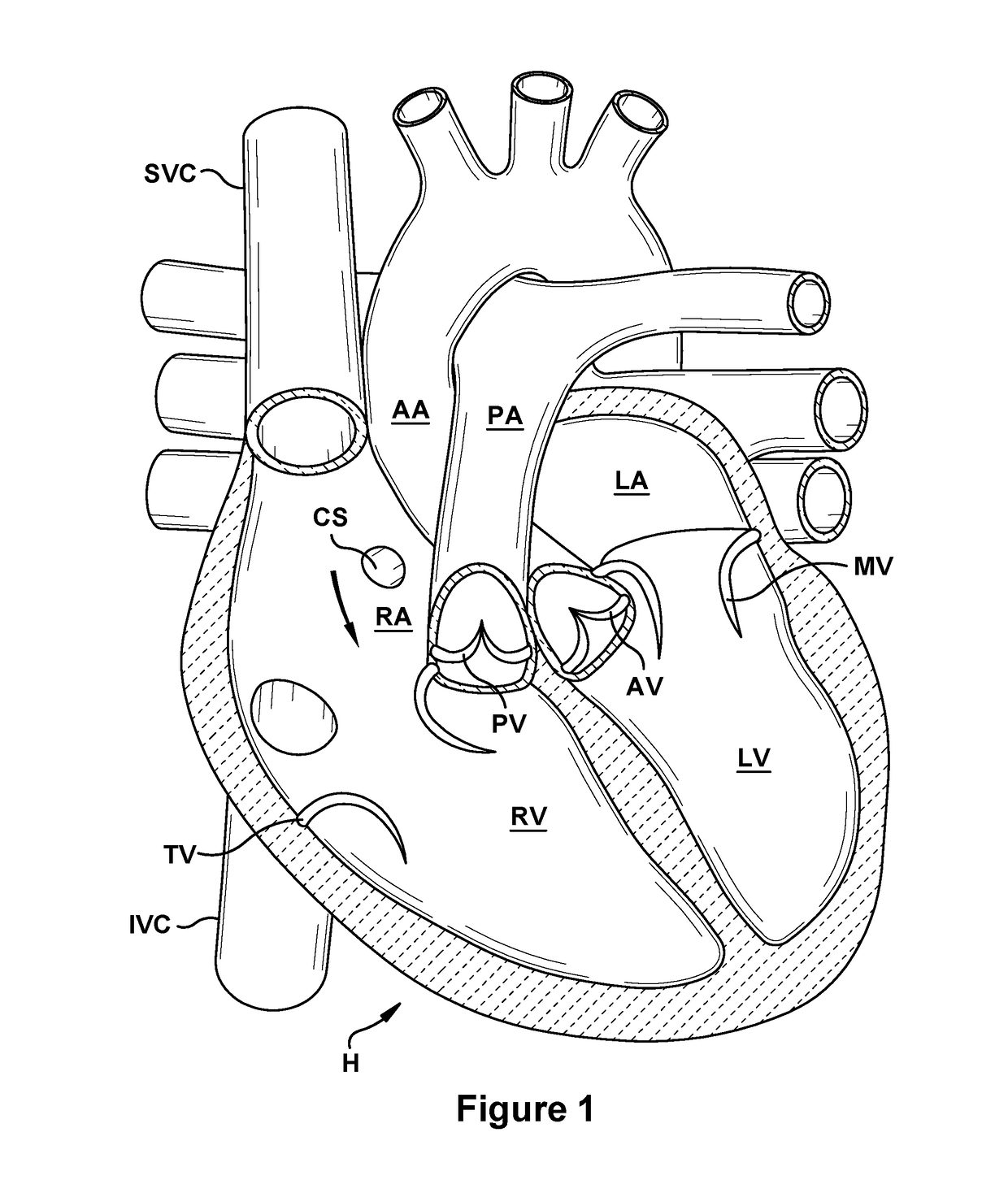 Native valve repair devices and procedures